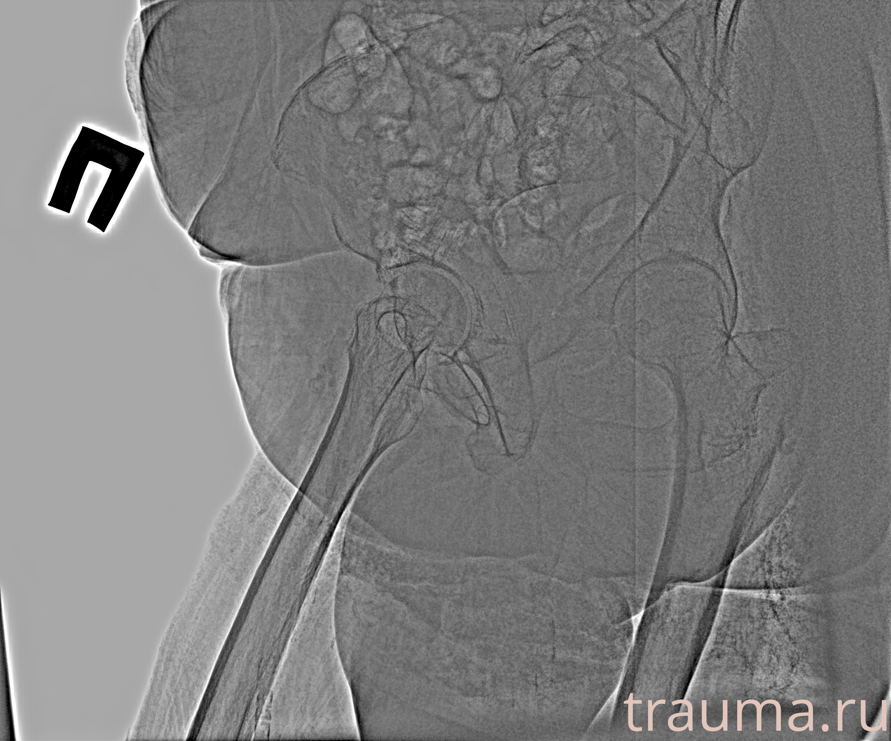 Рентген на дому: по вашему адресу приезжает врач-рентгенолог, травматолог-ортопед с мобильным рентгеновским аппаратом, проводит диагностику травмы или заболевания, делает необходимые рентгенограммы, дает рекомендации по дальнейшему лечению. Получить качественные снимки в домашних условиях возможно благодаря уникальной методике, разработанной МосРентген Центром для института  Склифосовского