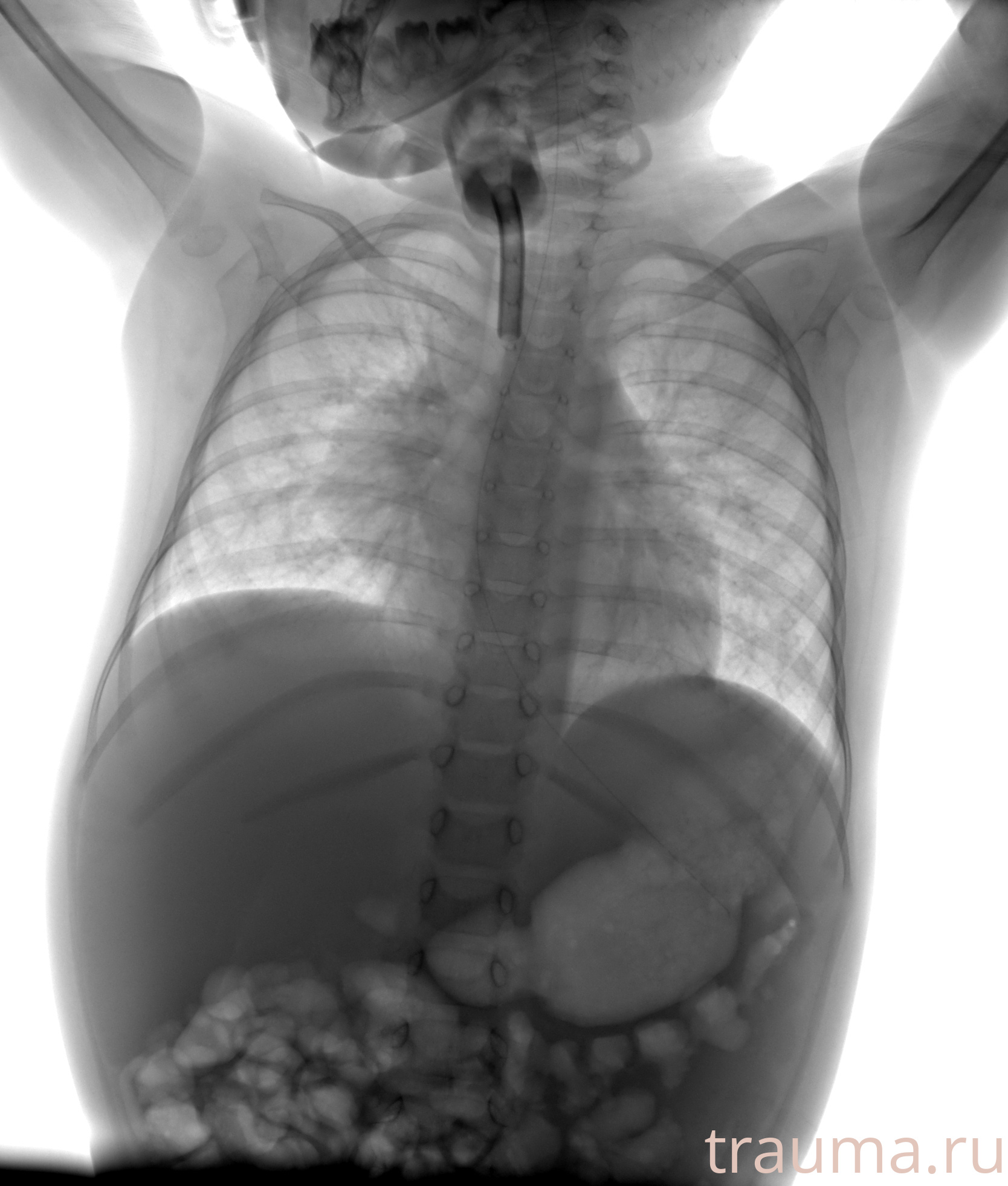 Рентген на дому: по вашему адресу приезжает врач-рентгенолог, травматолог-ортопед с мобильным рентгеновским аппаратом, проводит диагностику травмы или заболевания, делает необходимые рентгенограммы, дает рекомендации по дальнейшему лечению. Получить качественные снимки в домашних условиях возможно благодаря уникальной методике, разработанной МосРентген Центром для института  Склифосовского