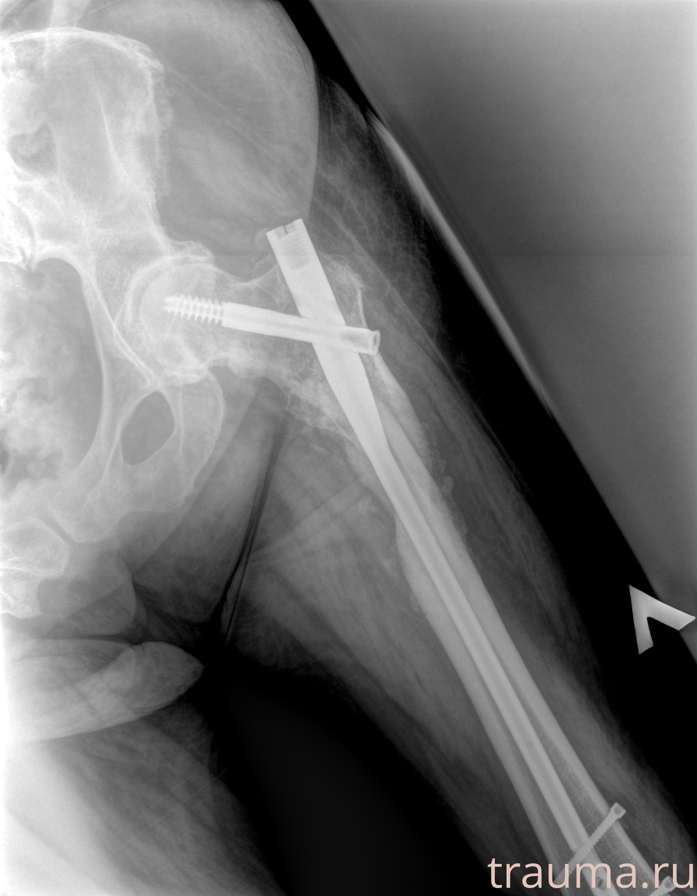 Рентген на дому: по вашему адресу приезжает врач-рентгенолог, травматолог-ортопед с мобильным рентгеновским аппаратом, проводит диагностику травмы или заболевания, делает необходимые рентгенограммы, дает рекомендации по дальнейшему лечению. Получить качественные снимки в домашних условиях возможно благодаря уникальной методике, разработанной МосРентген Центром для института  Склифосовского