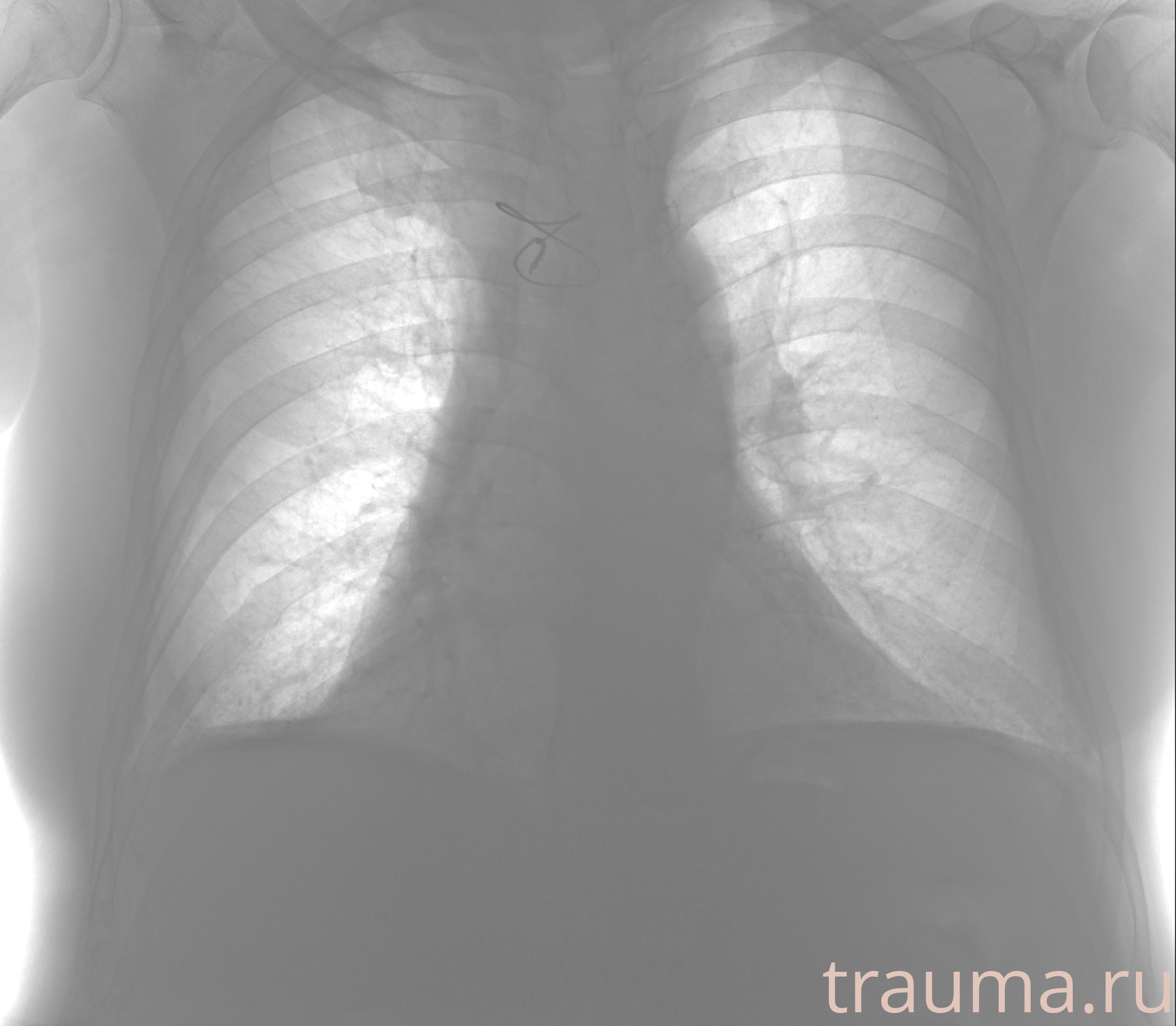 Рентген на дому: по вашему адресу приезжает врач-рентгенолог, травматолог-ортопед с мобильным рентгеновским аппаратом, проводит диагностику травмы или заболевания, делает необходимые рентгенограммы, дает рекомендации по дальнейшему лечению. Получить качественные снимки в домашних условиях возможно благодаря уникальной методике, разработанной МосРентген Центром для института  Склифосовского