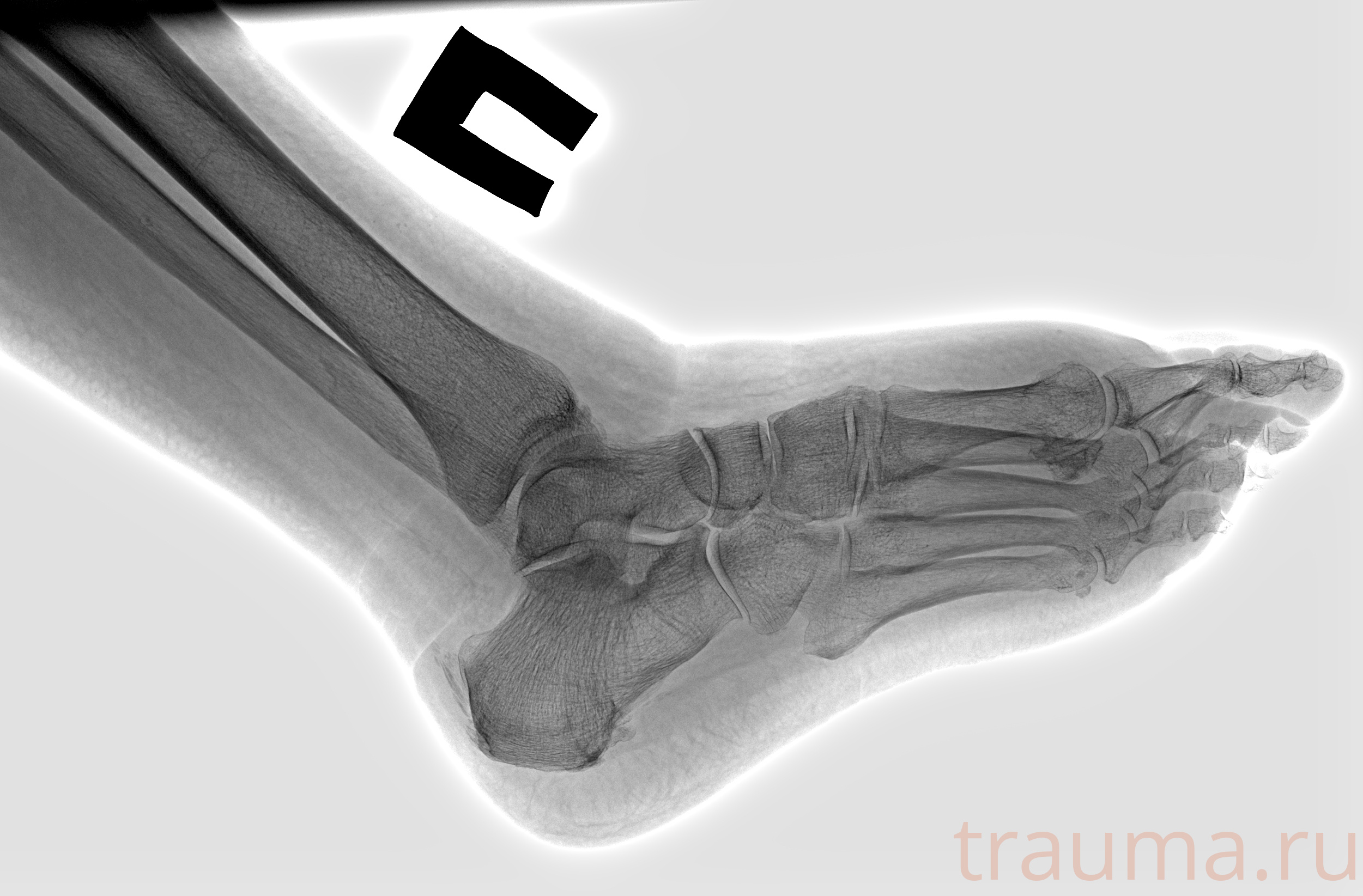 Рентген на дому: по вашему адресу приезжает врач-рентгенолог, травматолог-ортопед с мобильным рентгеновским аппаратом, проводит диагностику травмы или заболевания, делает необходимые рентгенограммы, дает рекомендации по дальнейшему лечению. Получить качественные снимки в домашних условиях возможно благодаря уникальной методике, разработанной МосРентген Центром для института  Склифосовского