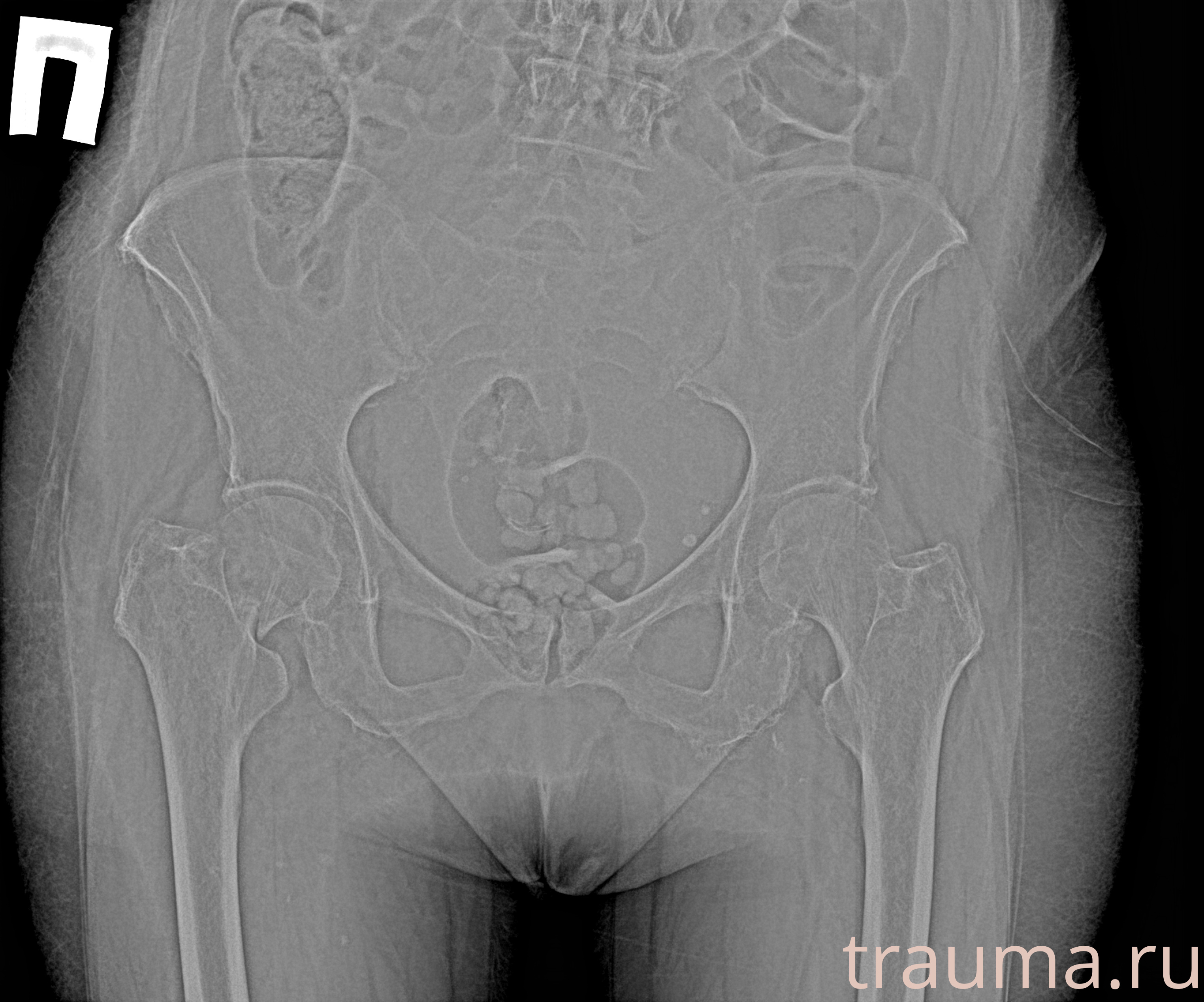 Рентген на дому: по вашему адресу приезжает врач-рентгенолог, травматолог-ортопед с мобильным рентгеновским аппаратом, проводит диагностику травмы или заболевания, делает необходимые рентгенограммы, дает рекомендации по дальнейшему лечению. Получить качественные снимки в домашних условиях возможно благодаря уникальной методике, разработанной МосРентген Центром для института  Склифосовского