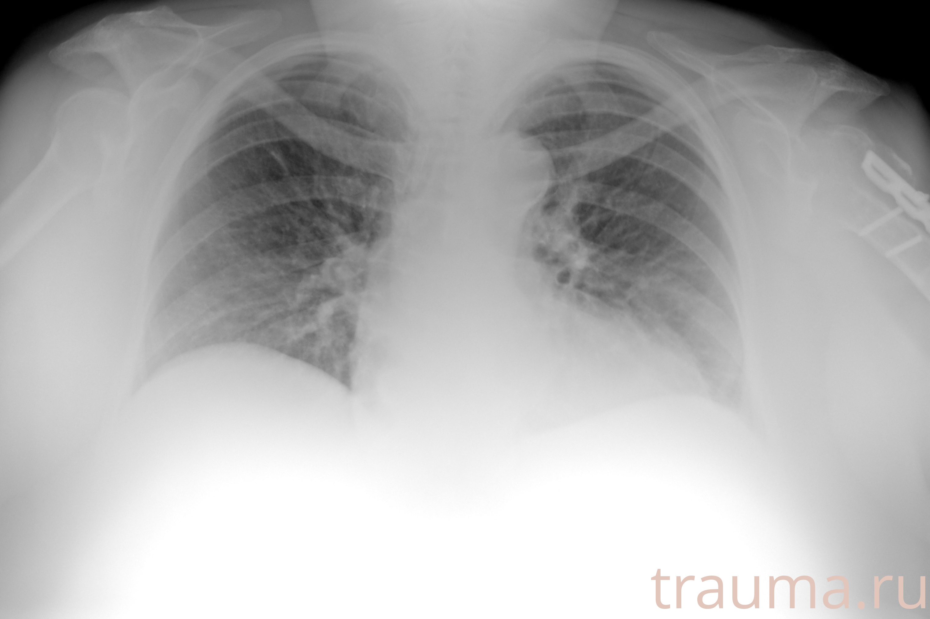 Рентген на дому: по вашему адресу приезжает врач-рентгенолог, травматолог-ортопед с мобильным рентгеновским аппаратом, проводит диагностику травмы или заболевания, делает необходимые рентгенограммы, дает рекомендации по дальнейшему лечению. Получить качественные снимки в домашних условиях возможно благодаря уникальной методике, разработанной МосРентген Центром для института  Склифосовского