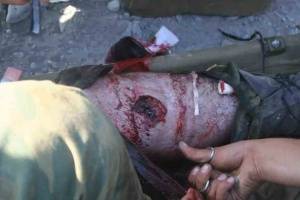 Боевые повреждения конечностей: роль способа и стабильности обездвиживания отломков в процессе сращения огнестрельных переломов Боевые повреждения конечностей: роль способа и стабильности обездвиживания отломков в процессе сращения огнестрельных переломов