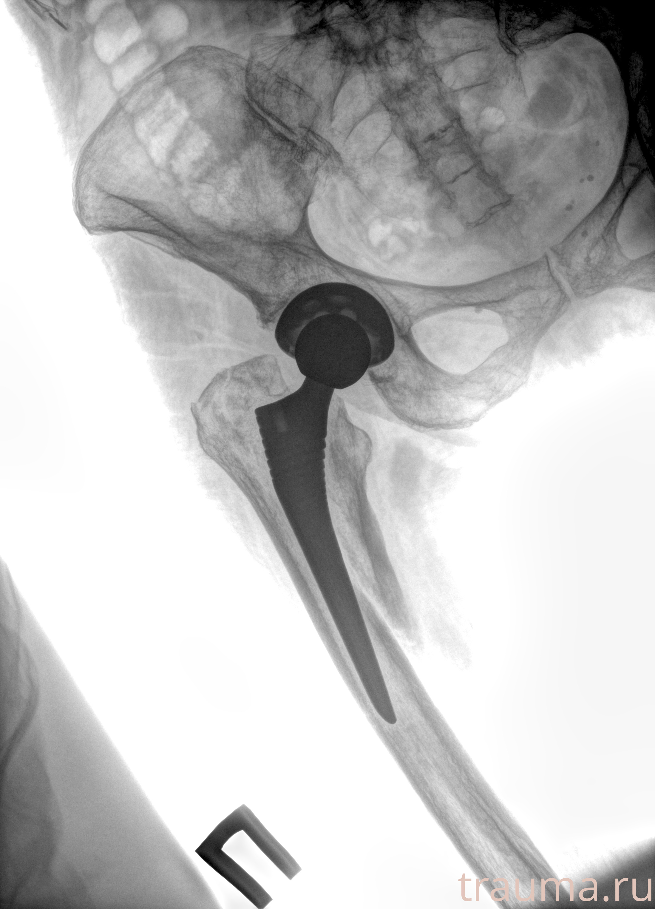 Рентген на дому: по вашему адресу приезжает врач-рентгенолог, травматолог-ортопед с мобильным рентгеновским аппаратом, проводит диагностику травмы или заболевания, делает необходимые рентгенограммы, дает рекомендации по дальнейшему лечению. Получить качественные снимки в домашних условиях возможно благодаря уникальной методике, разработанной МосРентген Центром для института  Склифосовского