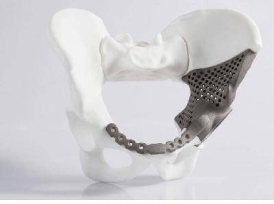 Замена пораженных раком костей таза титановым имплантом, изготовленным на 3D-принтере Замена пораженных раком костей таза титановым имплантом, изготовленным на 3D-принтере