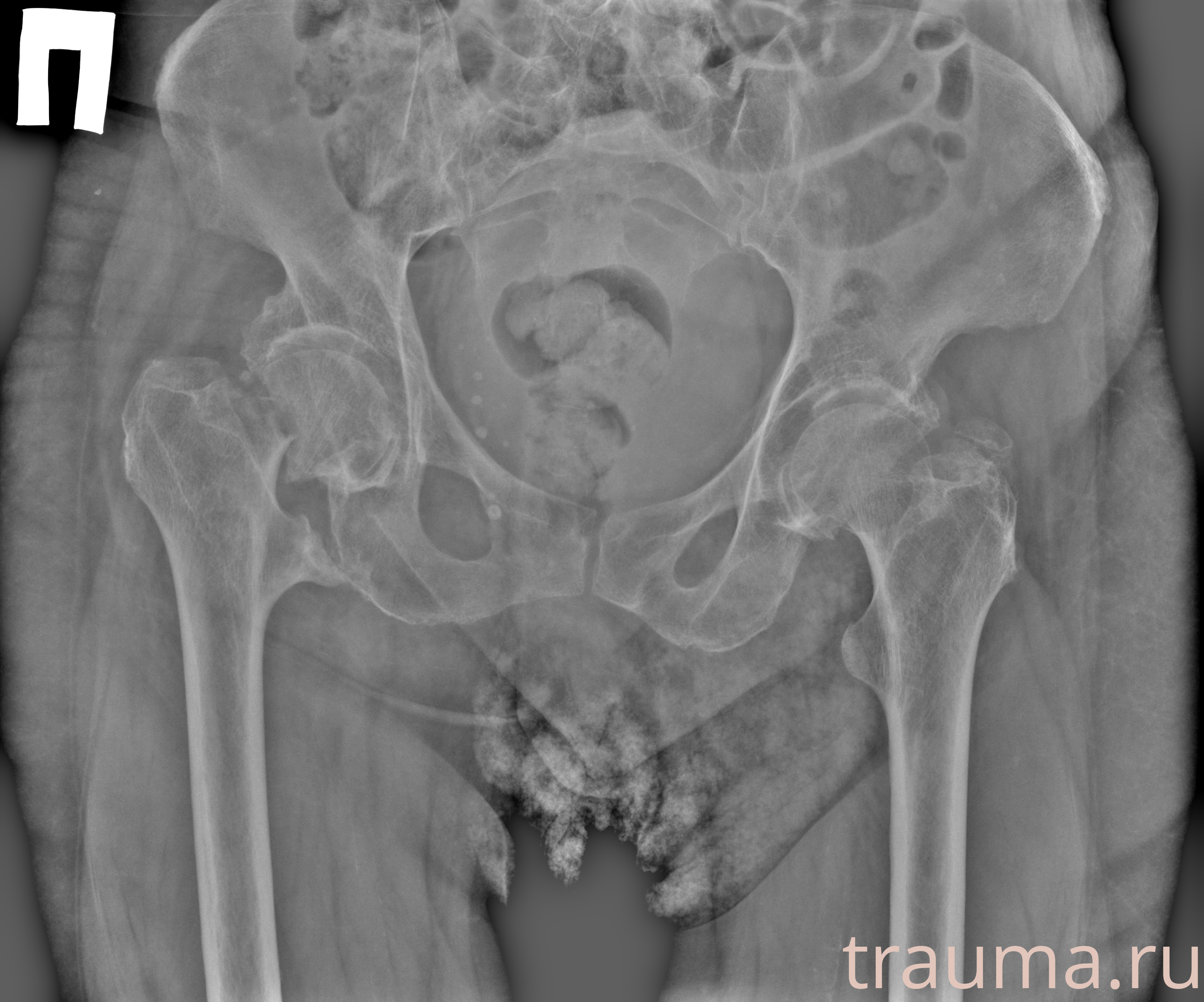 Рентген на дому: по вашему адресу приезжает врач-рентгенолог, травматолог-ортопед с мобильным рентгеновским аппаратом, проводит диагностику травмы или заболевания, делает необходимые рентгенограммы, дает рекомендации по дальнейшему лечению. Получить качественные снимки в домашних условиях возможно благодаря уникальной методике, разработанной МосРентген Центром для института  Склифосовского