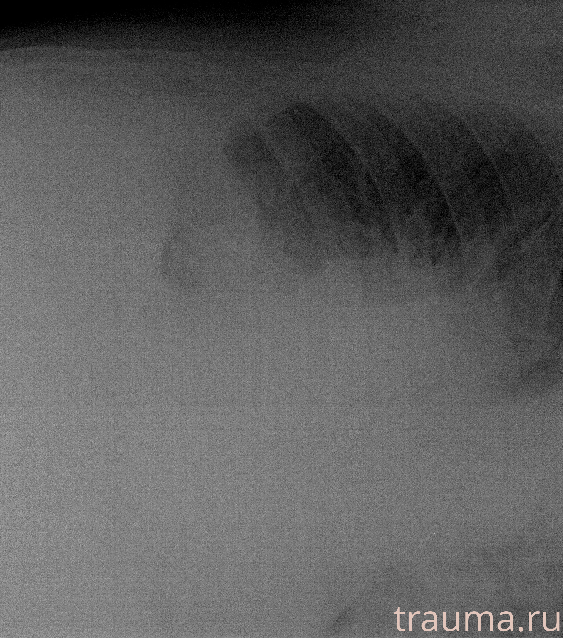 Рентген на дому: по вашему адресу приезжает врач-рентгенолог, травматолог-ортопед с мобильным рентгеновским аппаратом, проводит диагностику травмы или заболевания, делает необходимые рентгенограммы, дает рекомендации по дальнейшему лечению. Получить качественные снимки в домашних условиях возможно благодаря уникальной методике, разработанной МосРентген Центром для института  Склифосовского