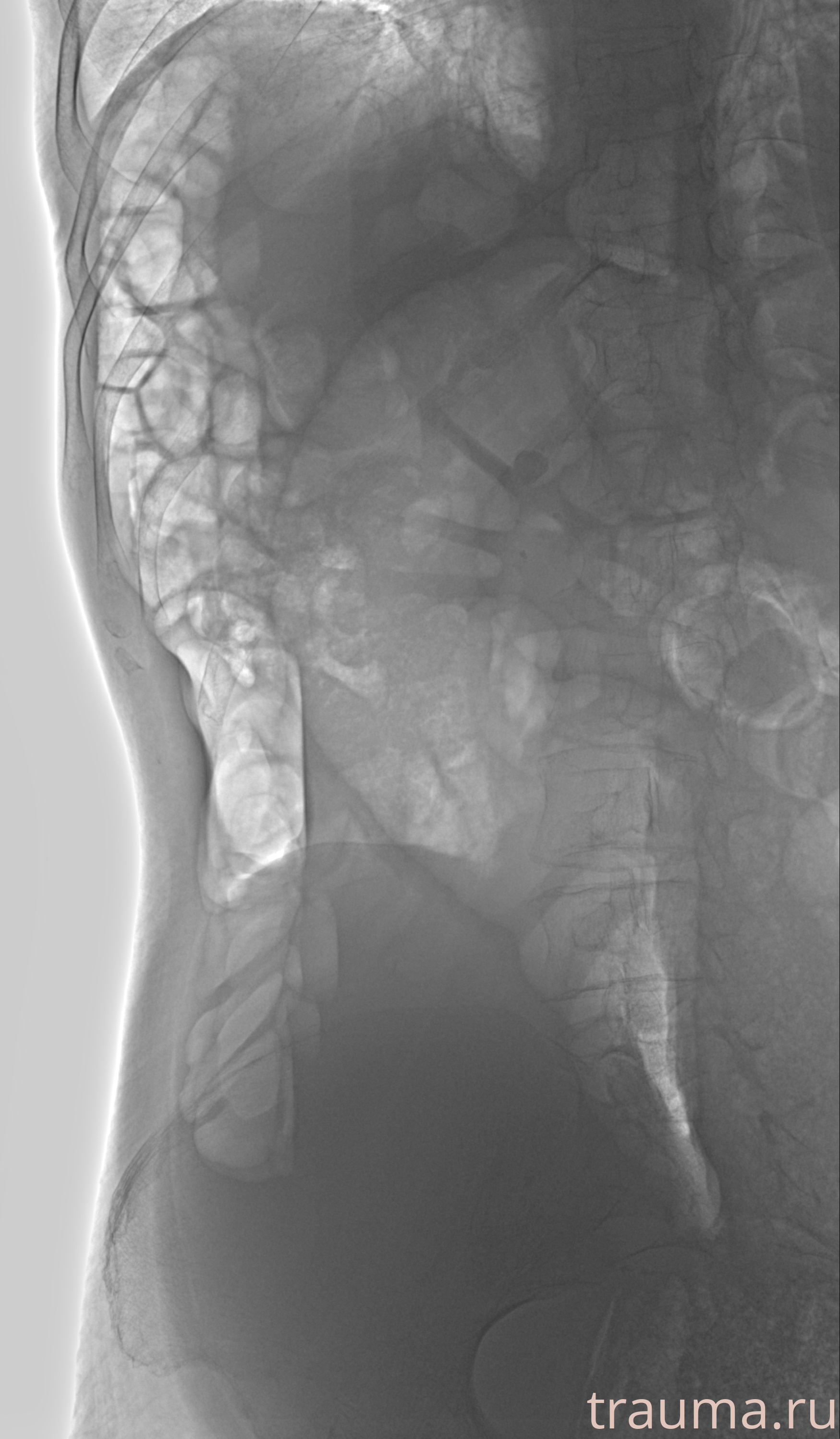 Рентген на дому: по вашему адресу приезжает врач-рентгенолог, травматолог-ортопед с мобильным рентгеновским аппаратом, проводит диагностику травмы или заболевания, делает необходимые рентгенограммы, дает рекомендации по дальнейшему лечению. Получить качественные снимки в домашних условиях возможно благодаря уникальной методике, разработанной МосРентген Центром для института  Склифосовского