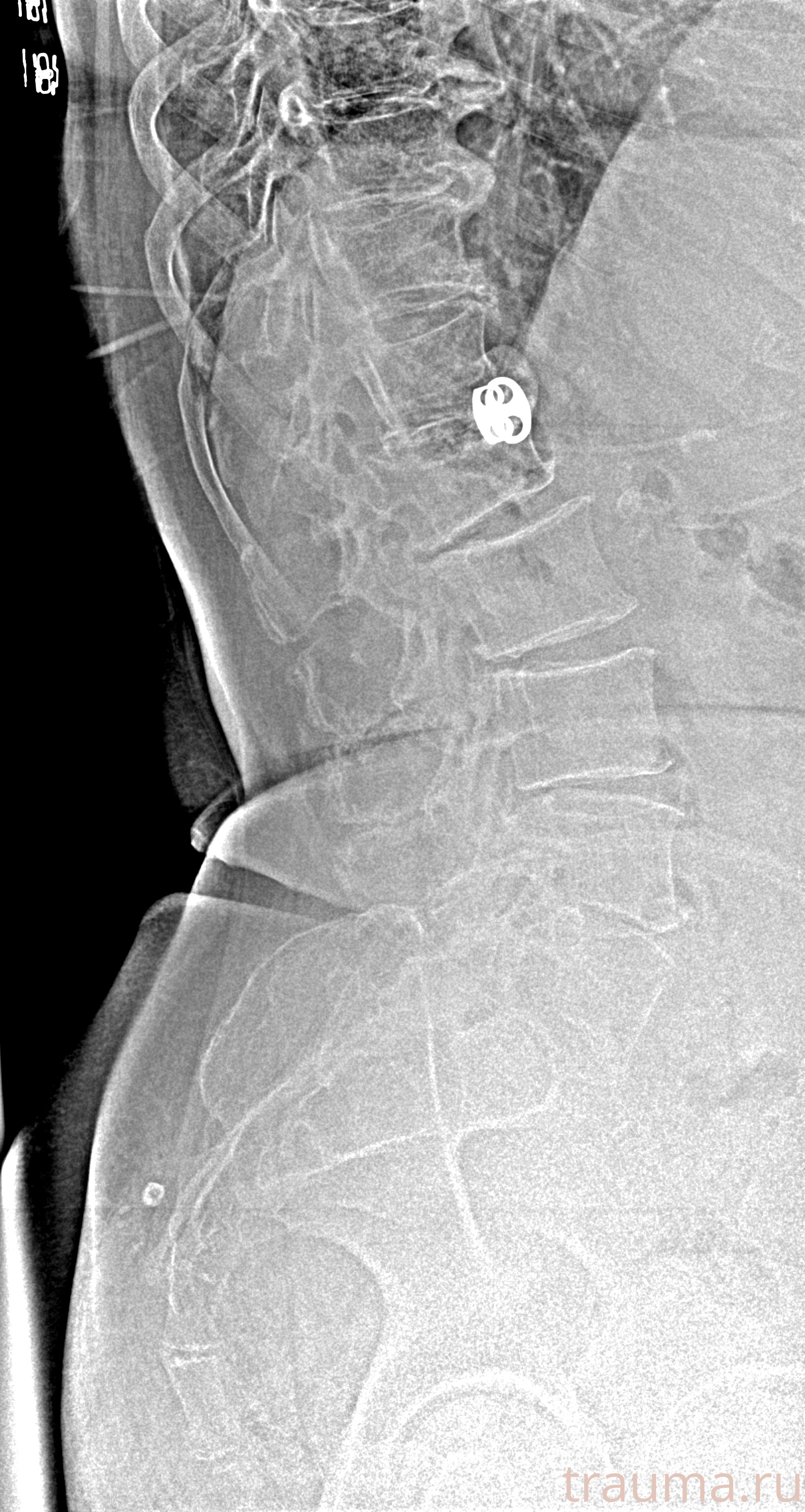 Рентген на дому: по вашему адресу приезжает врач-рентгенолог, травматолог-ортопед с мобильным рентгеновским аппаратом, проводит диагностику травмы или заболевания, делает необходимые рентгенограммы, дает рекомендации по дальнейшему лечению. Получить качественные снимки в домашних условиях возможно благодаря уникальной методике, разработанной МосРентген Центром для института  Склифосовского