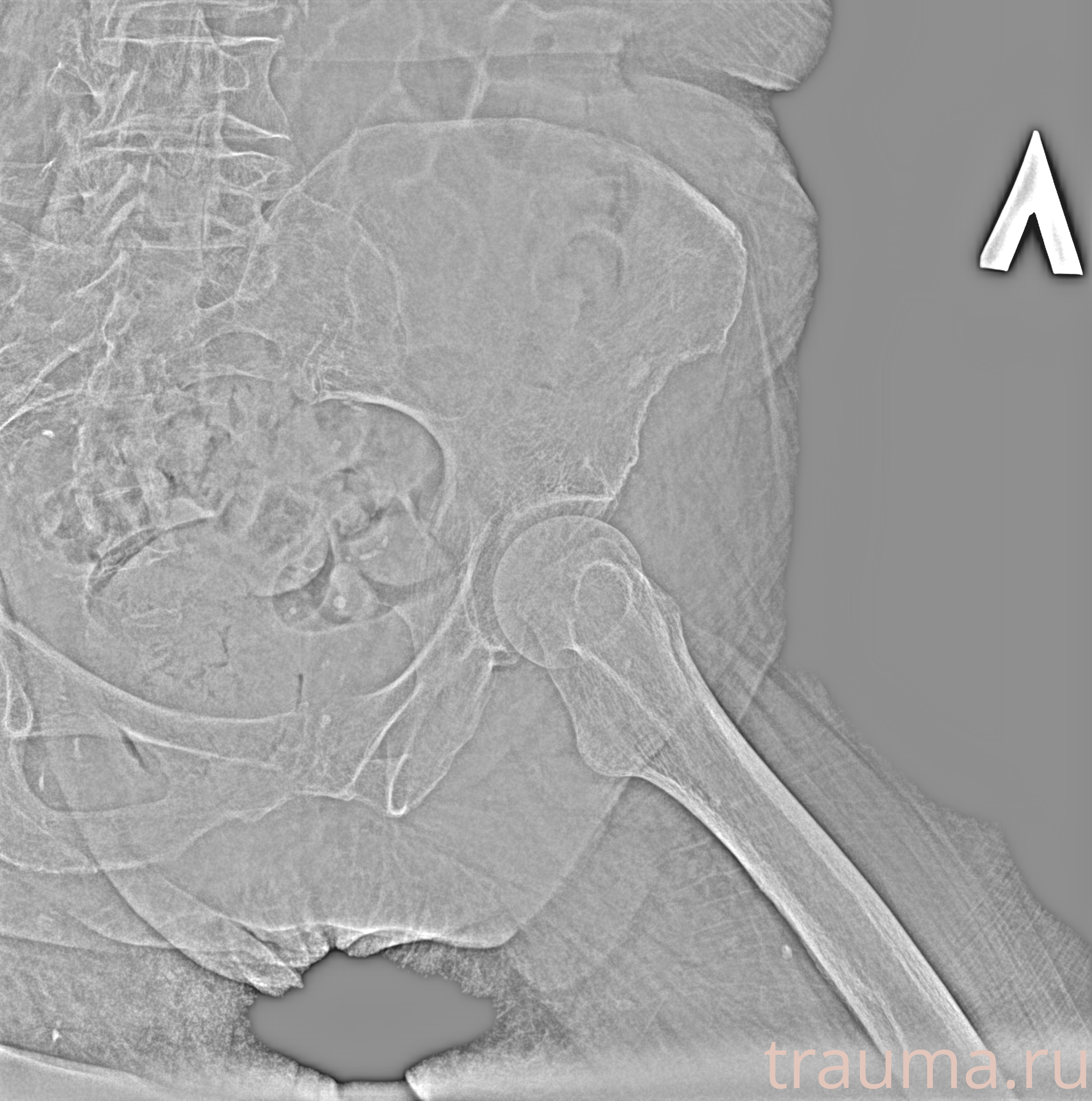 Рентген на дому: по вашему адресу приезжает врач-рентгенолог, травматолог-ортопед с мобильным рентгеновским аппаратом, проводит диагностику травмы или заболевания, делает необходимые рентгенограммы, дает рекомендации по дальнейшему лечению. Получить качественные снимки в домашних условиях возможно благодаря уникальной методике, разработанной МосРентген Центром для института  Склифосовского