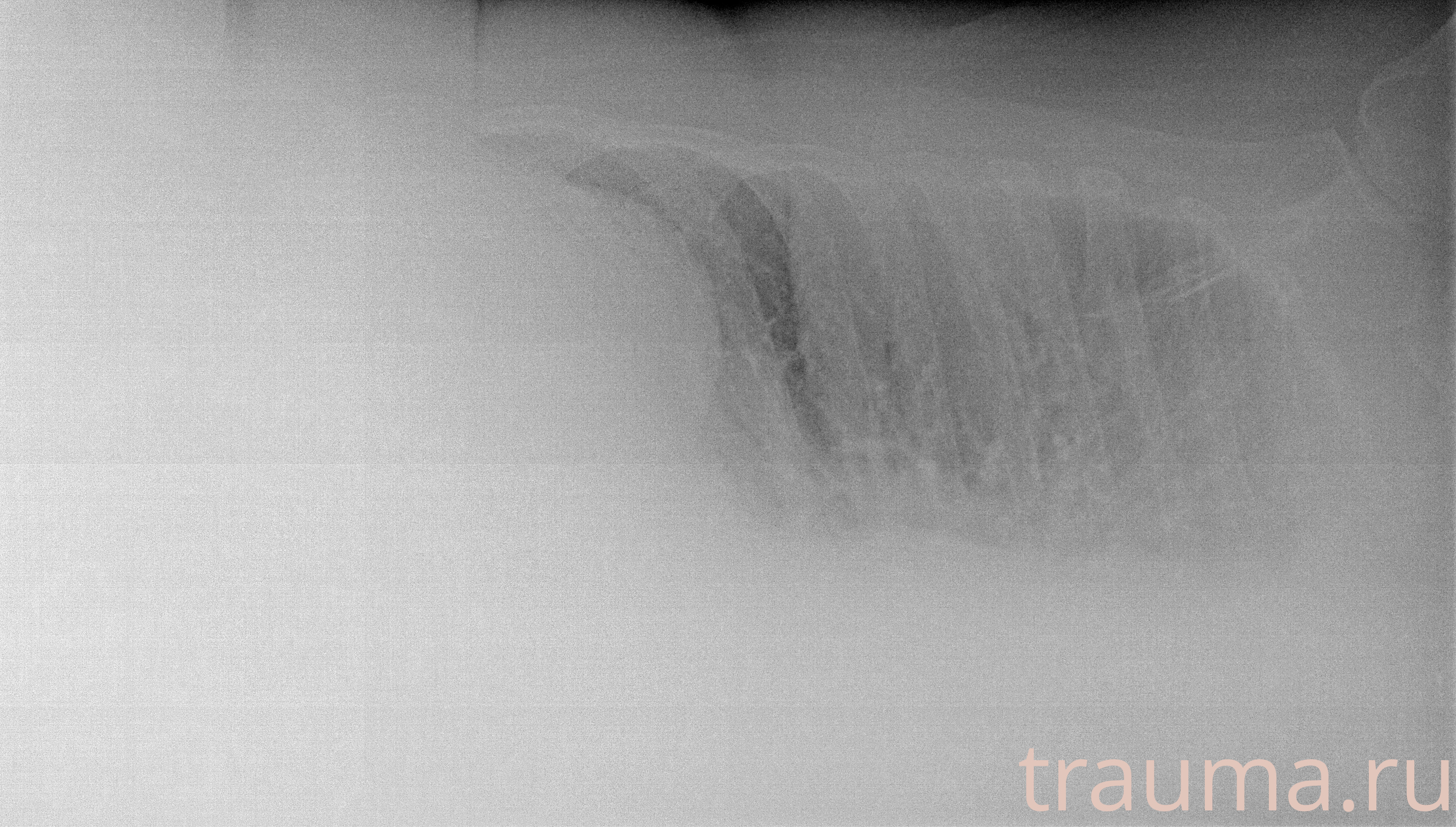 Рентген на дому: по вашему адресу приезжает врач-рентгенолог, травматолог-ортопед с мобильным рентгеновским аппаратом, проводит диагностику травмы или заболевания, делает необходимые рентгенограммы, дает рекомендации по дальнейшему лечению. Получить качественные снимки в домашних условиях возможно благодаря уникальной методике, разработанной МосРентген Центром для института  Склифосовского