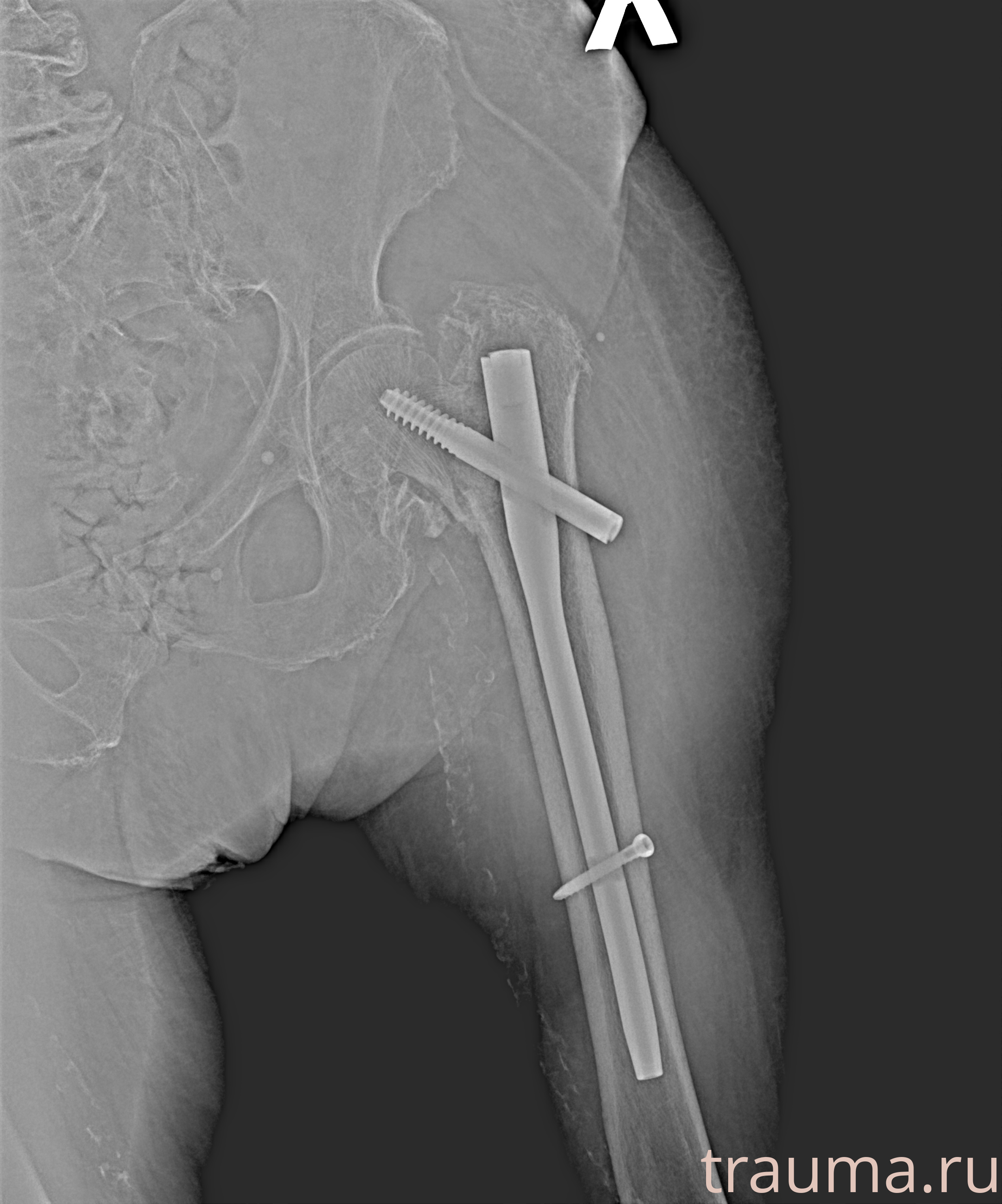Рентген на дому: по вашему адресу приезжает врач-рентгенолог, травматолог-ортопед с мобильным рентгеновским аппаратом, проводит диагностику травмы или заболевания, делает необходимые рентгенограммы, дает рекомендации по дальнейшему лечению. Получить качественные снимки в домашних условиях возможно благодаря уникальной методике, разработанной МосРентген Центром для института  Склифосовского