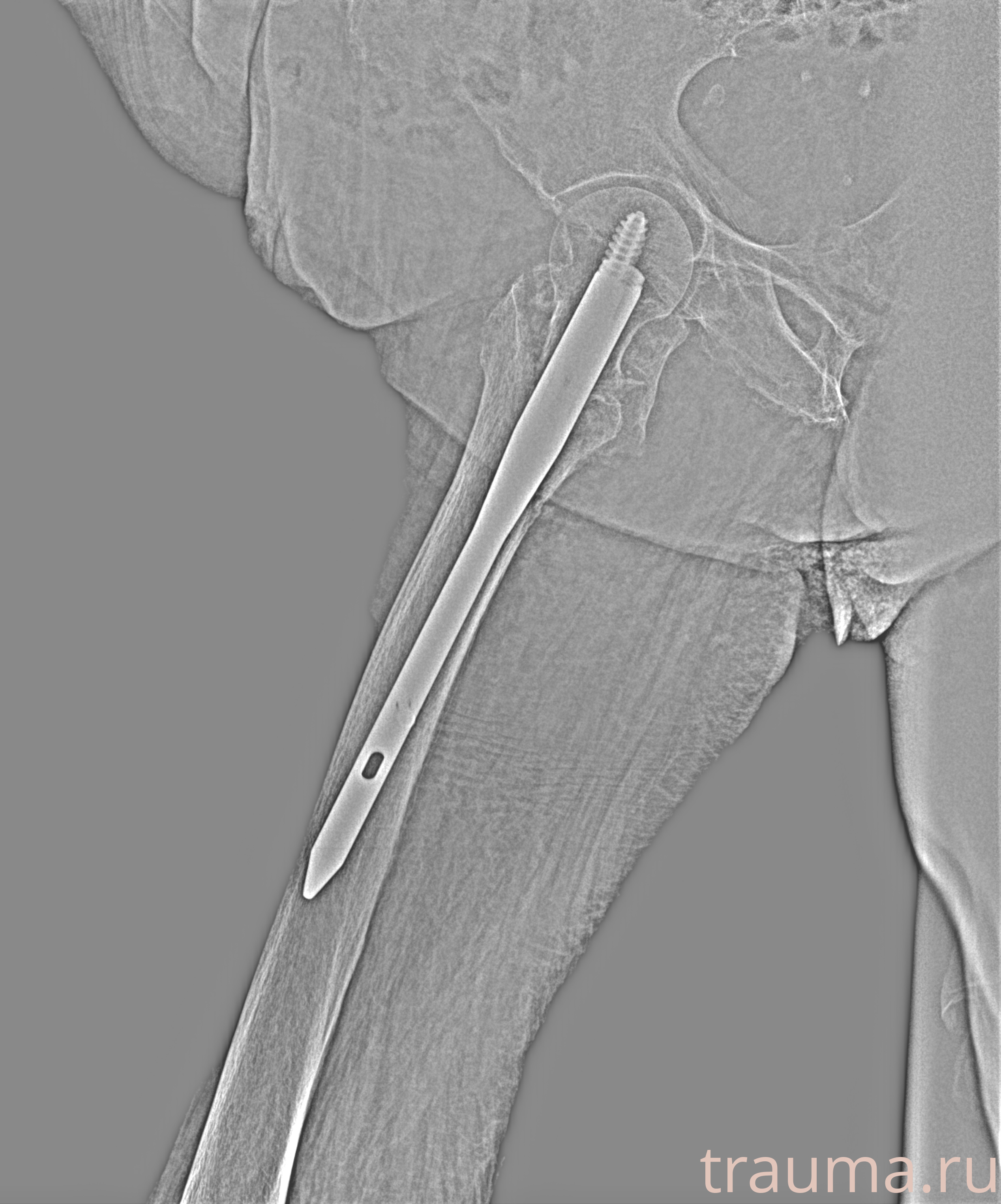Рентген на дому: по вашему адресу приезжает врач-рентгенолог, травматолог-ортопед с мобильным рентгеновским аппаратом, проводит диагностику травмы или заболевания, делает необходимые рентгенограммы, дает рекомендации по дальнейшему лечению. Получить качественные снимки в домашних условиях возможно благодаря уникальной методике, разработанной МосРентген Центром для института  Склифосовского