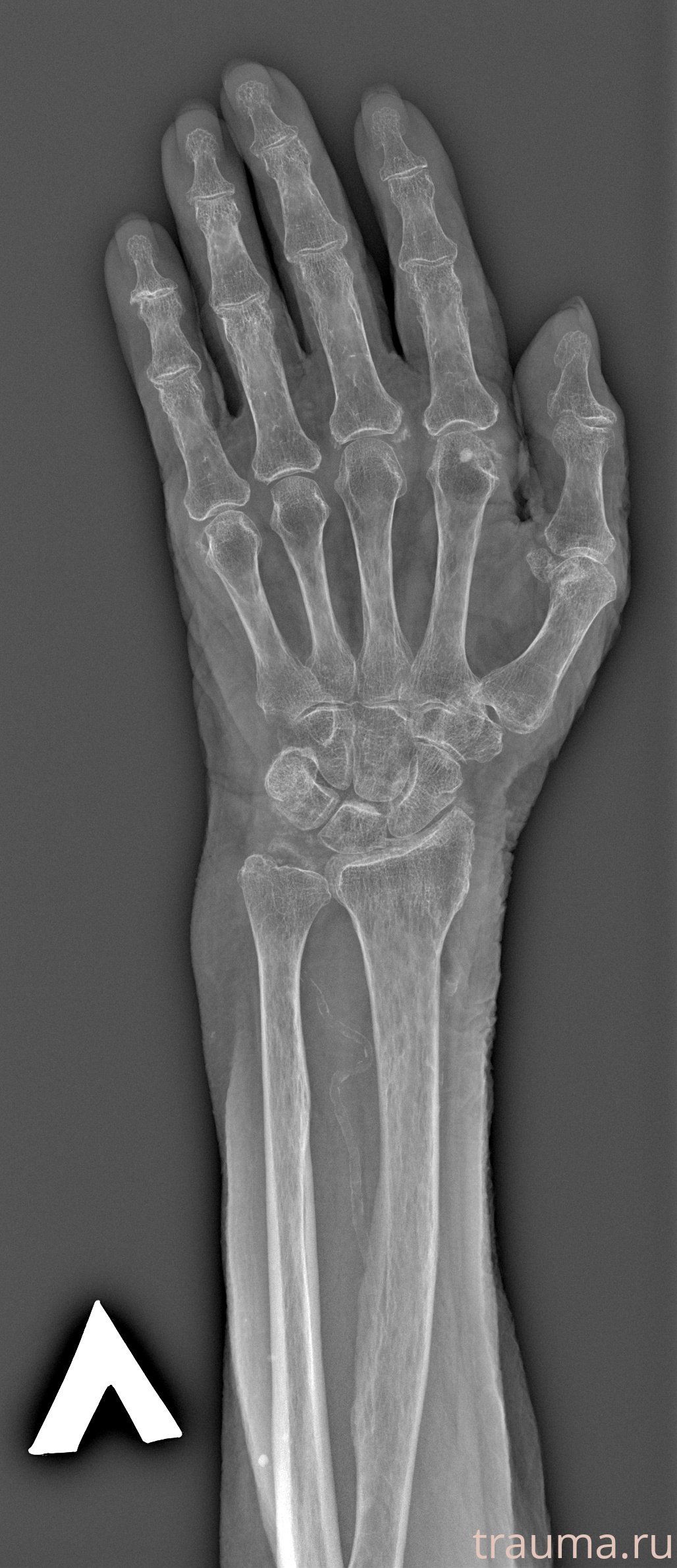 Рентген на дому: по вашему адресу приезжает врач-рентгенолог, травматолог-ортопед с мобильным рентгеновским аппаратом, проводит диагностику травмы или заболевания, делает необходимые рентгенограммы, дает рекомендации по дальнейшему лечению. Получить качественные снимки в домашних условиях возможно благодаря уникальной методике, разработанной МосРентген Центром для института  Склифосовского