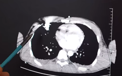 Скорая помощь доставила пациента в Склиф вместе с металлическим стержнем в корпусе Скорая помощь доставила пациента в Склиф вместе с металлическим стержнем в корпусе