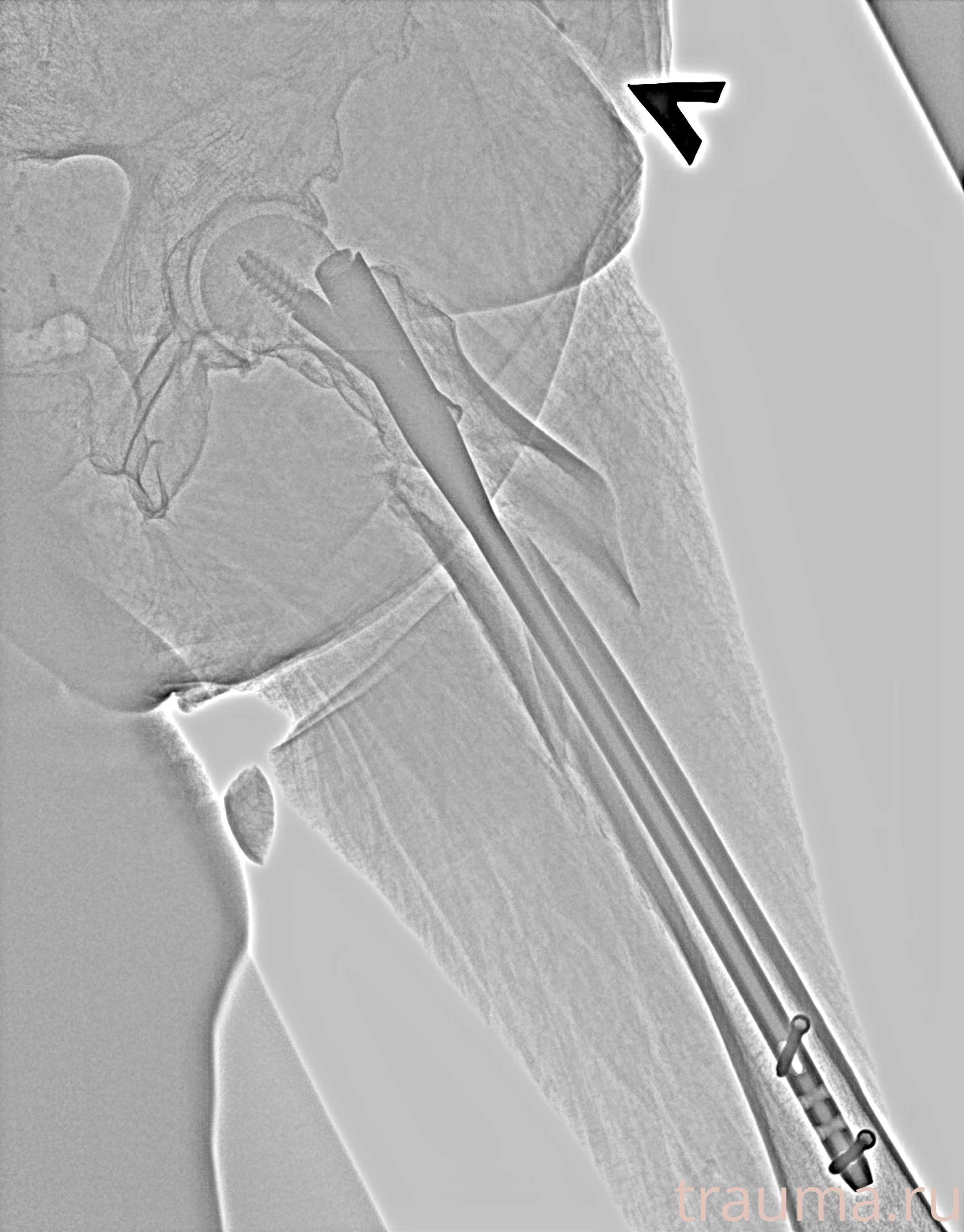 Рентген на дому: по вашему адресу приезжает врач-рентгенолог, травматолог-ортопед с мобильным рентгеновским аппаратом, проводит диагностику травмы или заболевания, делает необходимые рентгенограммы, дает рекомендации по дальнейшему лечению. Получить качественные снимки в домашних условиях возможно благодаря уникальной методике, разработанной МосРентген Центром для института  Склифосовского