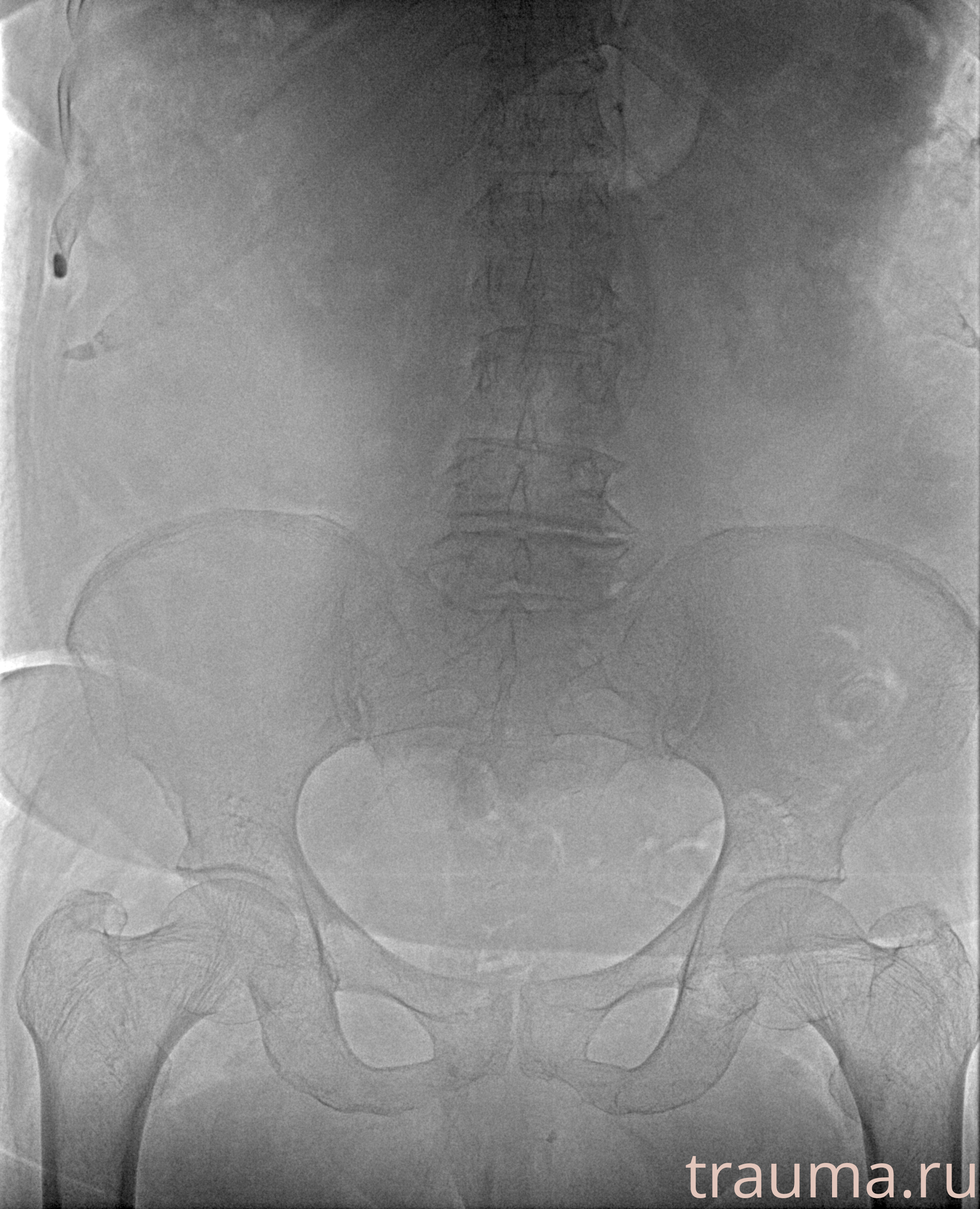 Рентген на дому: по вашему адресу приезжает врач-рентгенолог, травматолог-ортопед с мобильным рентгеновским аппаратом, проводит диагностику травмы или заболевания, делает необходимые рентгенограммы, дает рекомендации по дальнейшему лечению. Получить качественные снимки в домашних условиях возможно благодаря уникальной методике, разработанной МосРентген Центром для института  Склифосовского