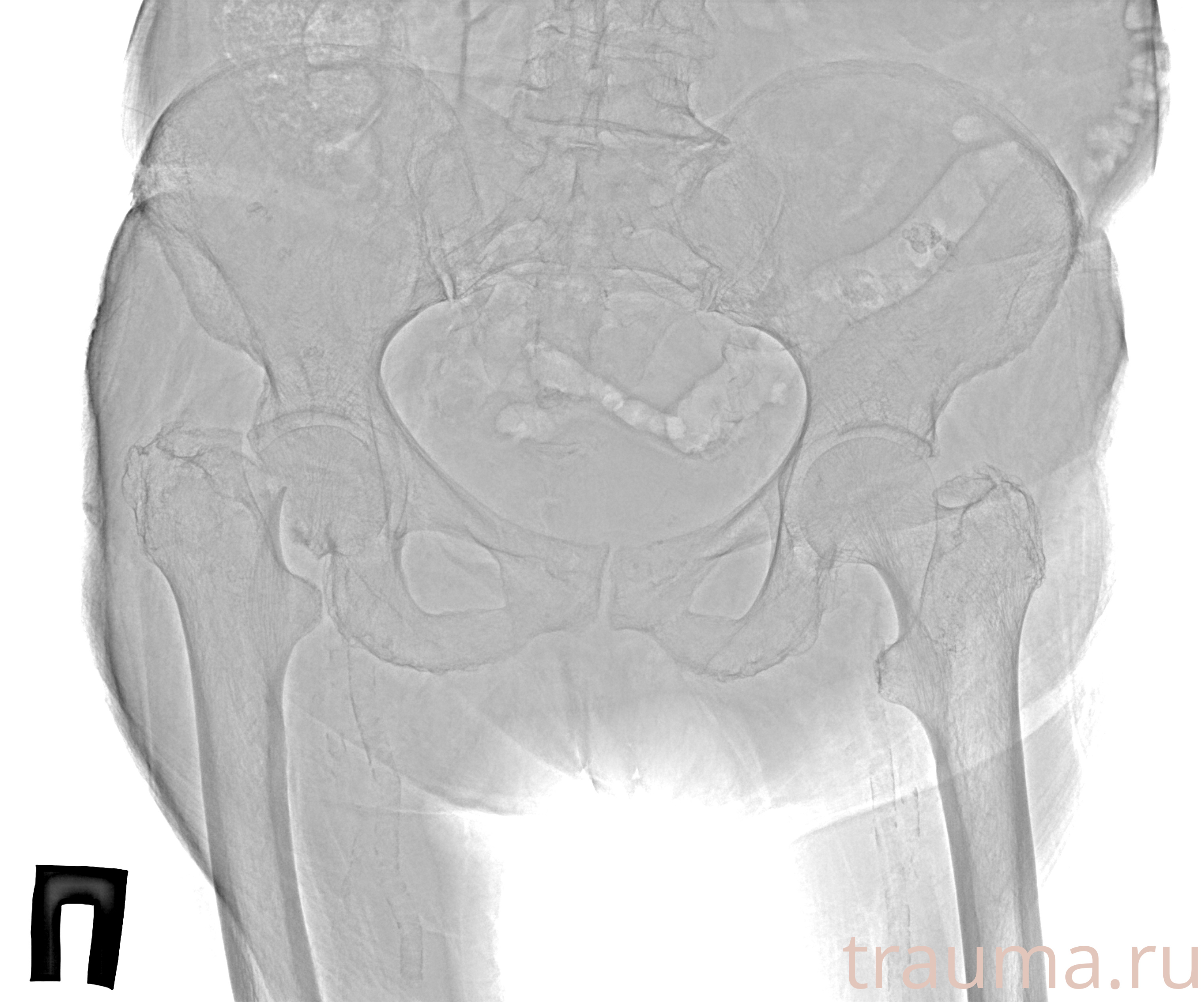 Рентген на дому: по вашему адресу приезжает врач-рентгенолог, травматолог-ортопед с мобильным рентгеновским аппаратом, проводит диагностику травмы или заболевания, делает необходимые рентгенограммы, дает рекомендации по дальнейшему лечению. Получить качественные снимки в домашних условиях возможно благодаря уникальной методике, разработанной МосРентген Центром для института  Склифосовского
