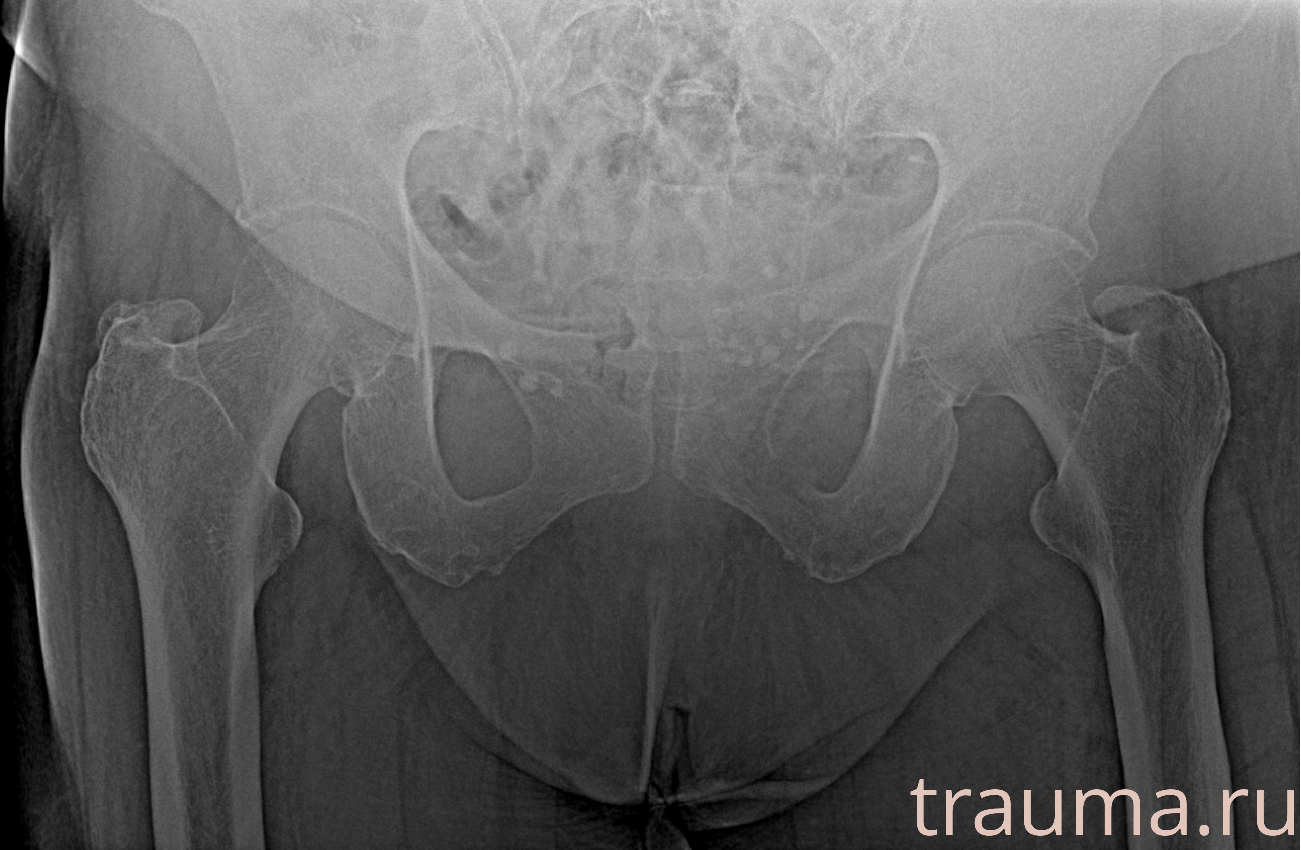 Рентген на дому: по вашему адресу приезжает врач-рентгенолог, травматолог-ортопед с мобильным рентгеновским аппаратом, проводит диагностику травмы или заболевания, делает необходимые рентгенограммы, дает рекомендации по дальнейшему лечению. Получить качественные снимки в домашних условиях возможно благодаря уникальной методике, разработанной МосРентген Центром для института  Склифосовского