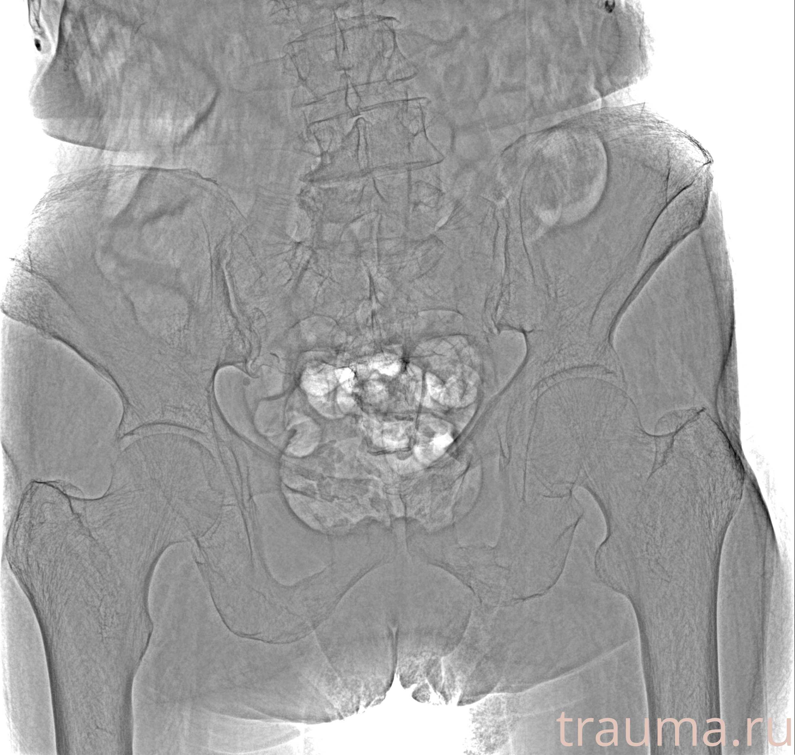 Рентген на дому: по вашему адресу приезжает врач-рентгенолог, травматолог-ортопед с мобильным рентгеновским аппаратом, проводит диагностику травмы или заболевания, делает необходимые рентгенограммы, дает рекомендации по дальнейшему лечению. Получить качественные снимки в домашних условиях возможно благодаря уникальной методике, разработанной МосРентген Центром для института  Склифосовского