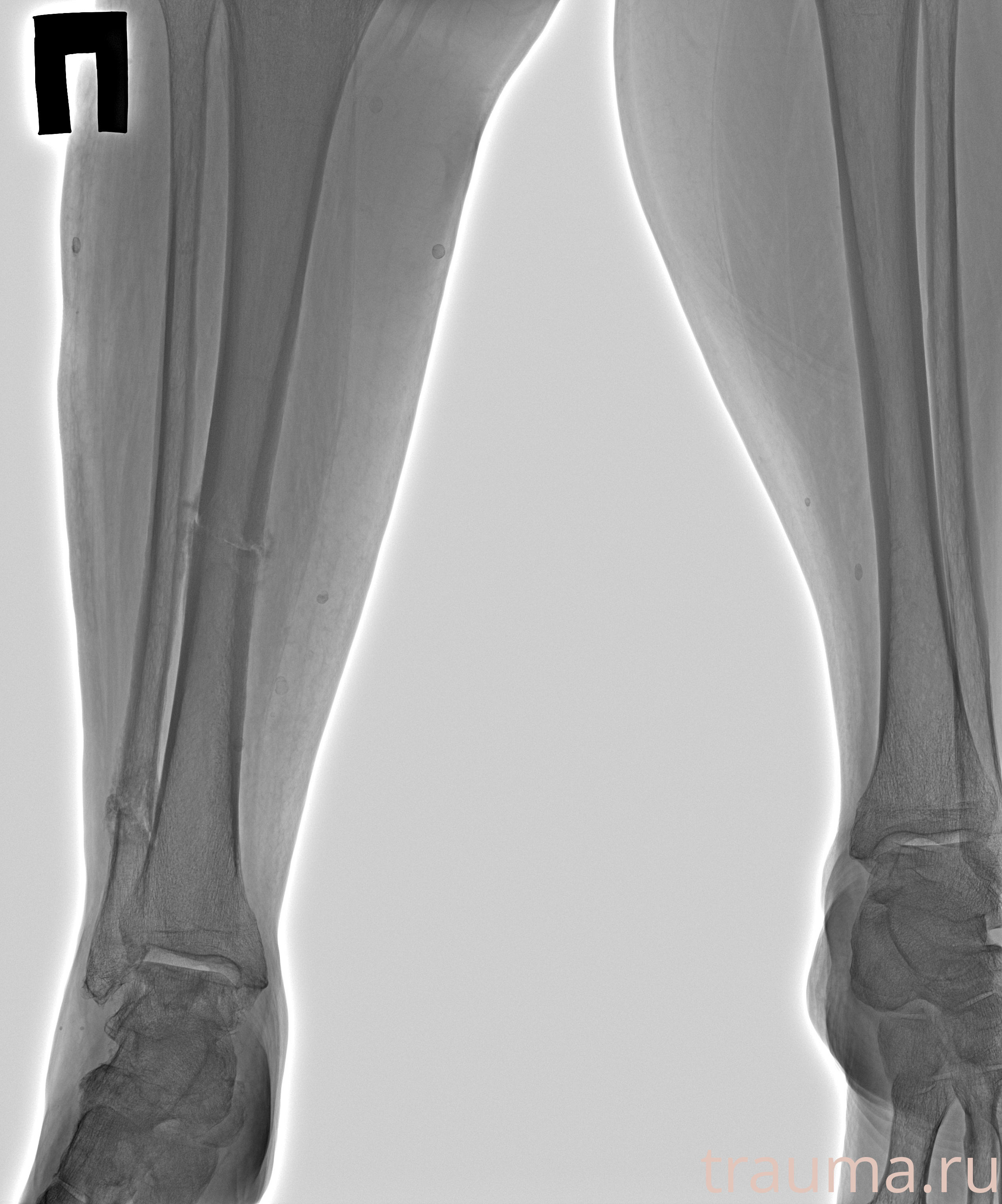 Рентген на дому: по вашему адресу приезжает врач-рентгенолог, травматолог-ортопед с мобильным рентгеновским аппаратом, проводит диагностику травмы или заболевания, делает необходимые рентгенограммы, дает рекомендации по дальнейшему лечению. Получить качественные снимки в домашних условиях возможно благодаря уникальной методике, разработанной МосРентген Центром для института  Склифосовского