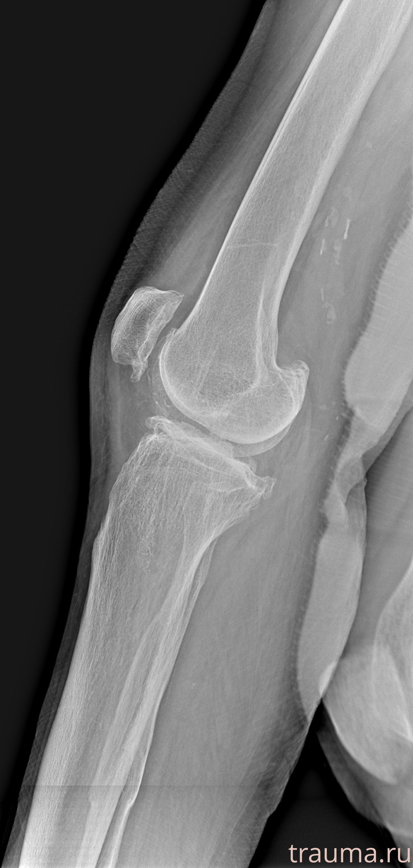 Рентген на дому: по вашему адресу приезжает врач-рентгенолог, травматолог-ортопед с мобильным рентгеновским аппаратом, проводит диагностику травмы или заболевания, делает необходимые рентгенограммы, дает рекомендации по дальнейшему лечению. Получить качественные снимки в домашних условиях возможно благодаря уникальной методике, разработанной МосРентген Центром для института  Склифосовского