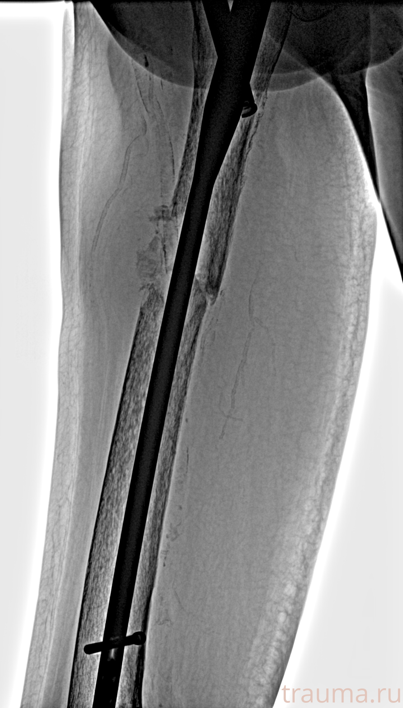 Рентген на дому: по вашему адресу приезжает врач-рентгенолог, травматолог-ортопед с мобильным рентгеновским аппаратом, проводит диагностику травмы или заболевания, делает необходимые рентгенограммы, дает рекомендации по дальнейшему лечению. Получить качественные снимки в домашних условиях возможно благодаря уникальной методике, разработанной МосРентген Центром для института  Склифосовского