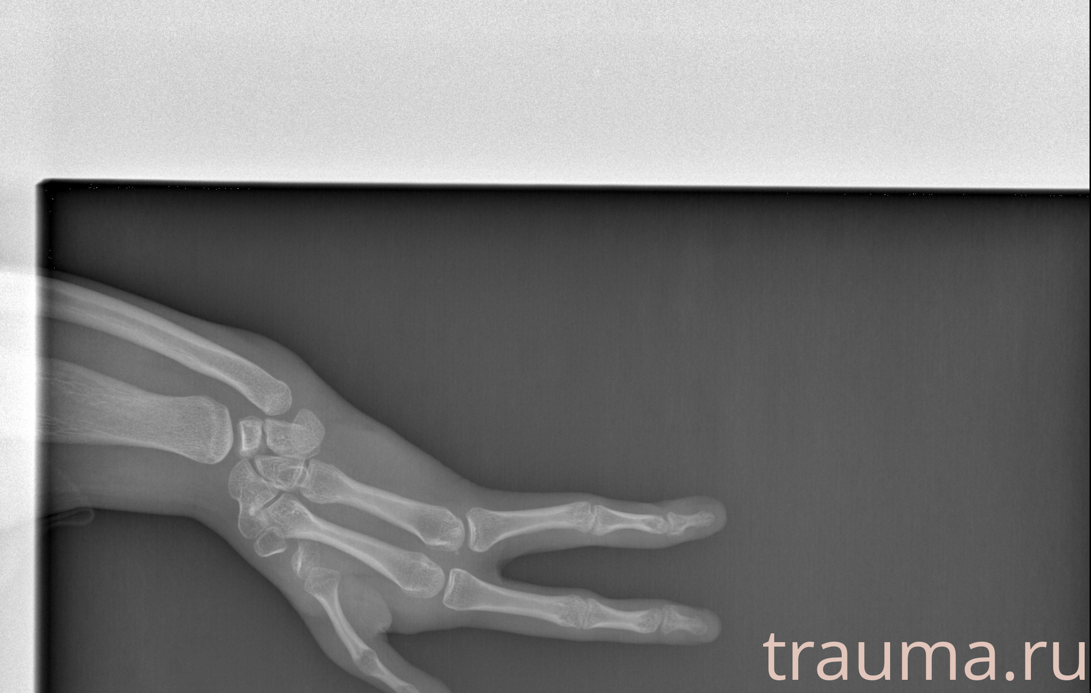 Рентген на дому: по вашему адресу приезжает врач-рентгенолог, травматолог-ортопед с мобильным рентгеновским аппаратом, проводит диагностику травмы или заболевания, делает необходимые рентгенограммы, дает рекомендации по дальнейшему лечению. Получить качественные снимки в домашних условиях возможно благодаря уникальной методике, разработанной МосРентген Центром для института  Склифосовского