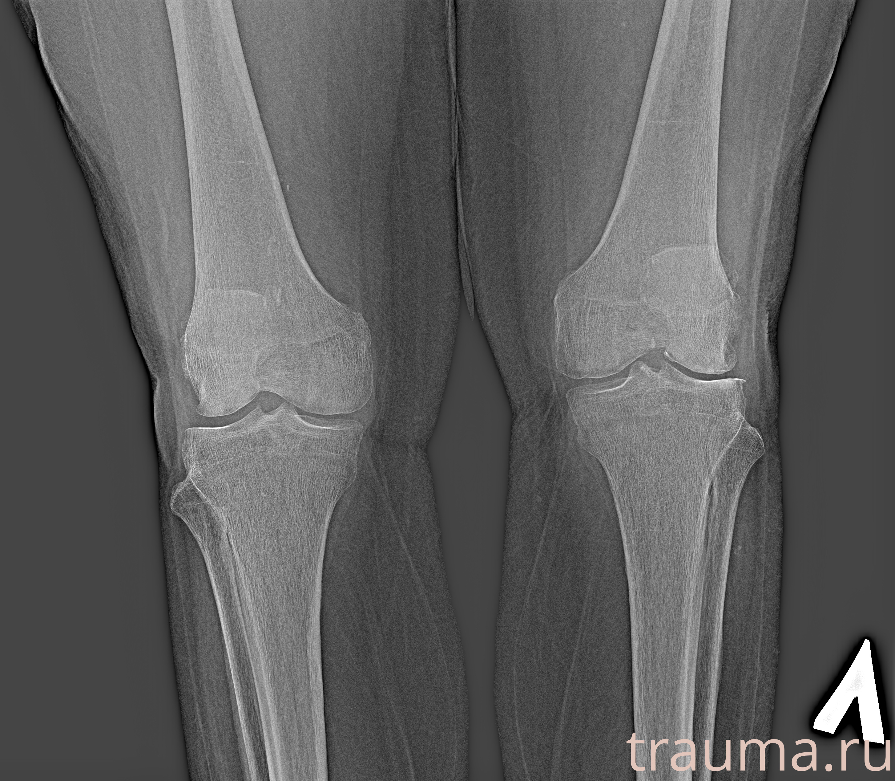 Рентген на дому: по вашему адресу приезжает врач-рентгенолог, травматолог-ортопед с мобильным рентгеновским аппаратом, проводит диагностику травмы или заболевания, делает необходимые рентгенограммы, дает рекомендации по дальнейшему лечению. Получить качественные снимки в домашних условиях возможно благодаря уникальной методике, разработанной МосРентген Центром для института  Склифосовского
