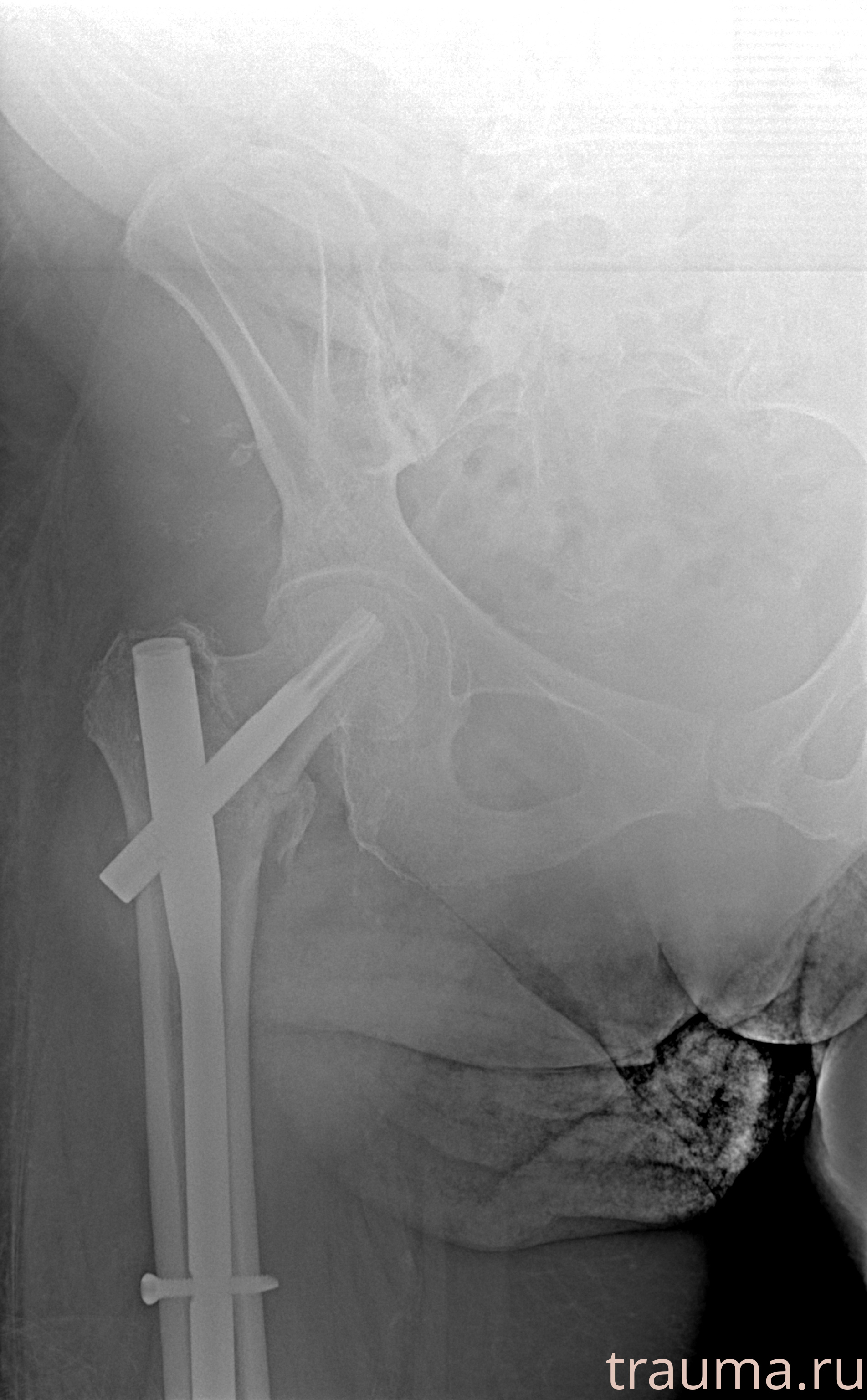 Рентген на дому: по вашему адресу приезжает врач-рентгенолог, травматолог-ортопед с мобильным рентгеновским аппаратом, проводит диагностику травмы или заболевания, делает необходимые рентгенограммы, дает рекомендации по дальнейшему лечению. Получить качественные снимки в домашних условиях возможно благодаря уникальной методике, разработанной МосРентген Центром для института  Склифосовского