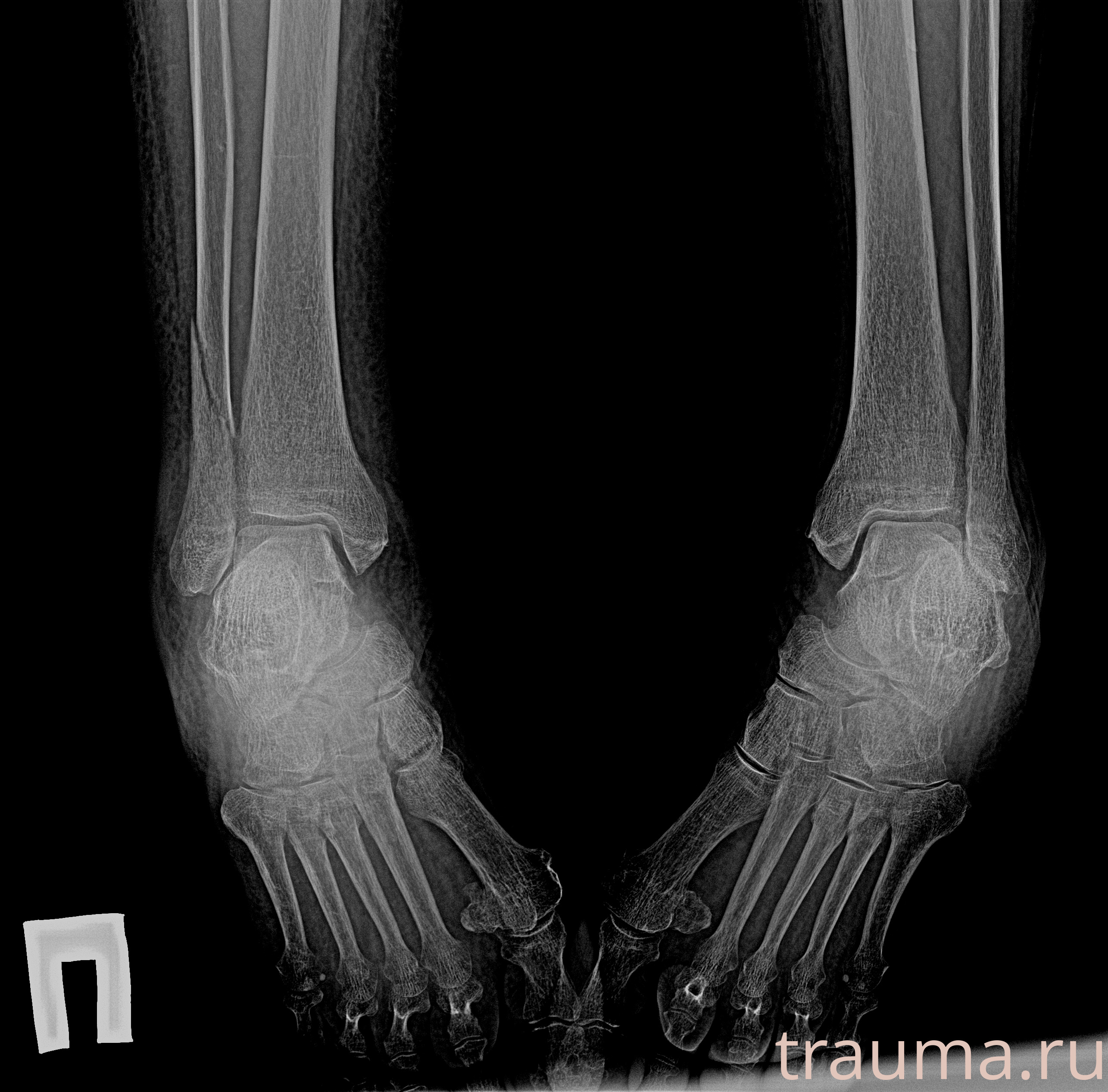 Рентген на дому: по вашему адресу приезжает врач-рентгенолог, травматолог-ортопед с мобильным рентгеновским аппаратом, проводит диагностику травмы или заболевания, делает необходимые рентгенограммы, дает рекомендации по дальнейшему лечению. Получить качественные снимки в домашних условиях возможно благодаря уникальной методике, разработанной МосРентген Центром для института  Склифосовского