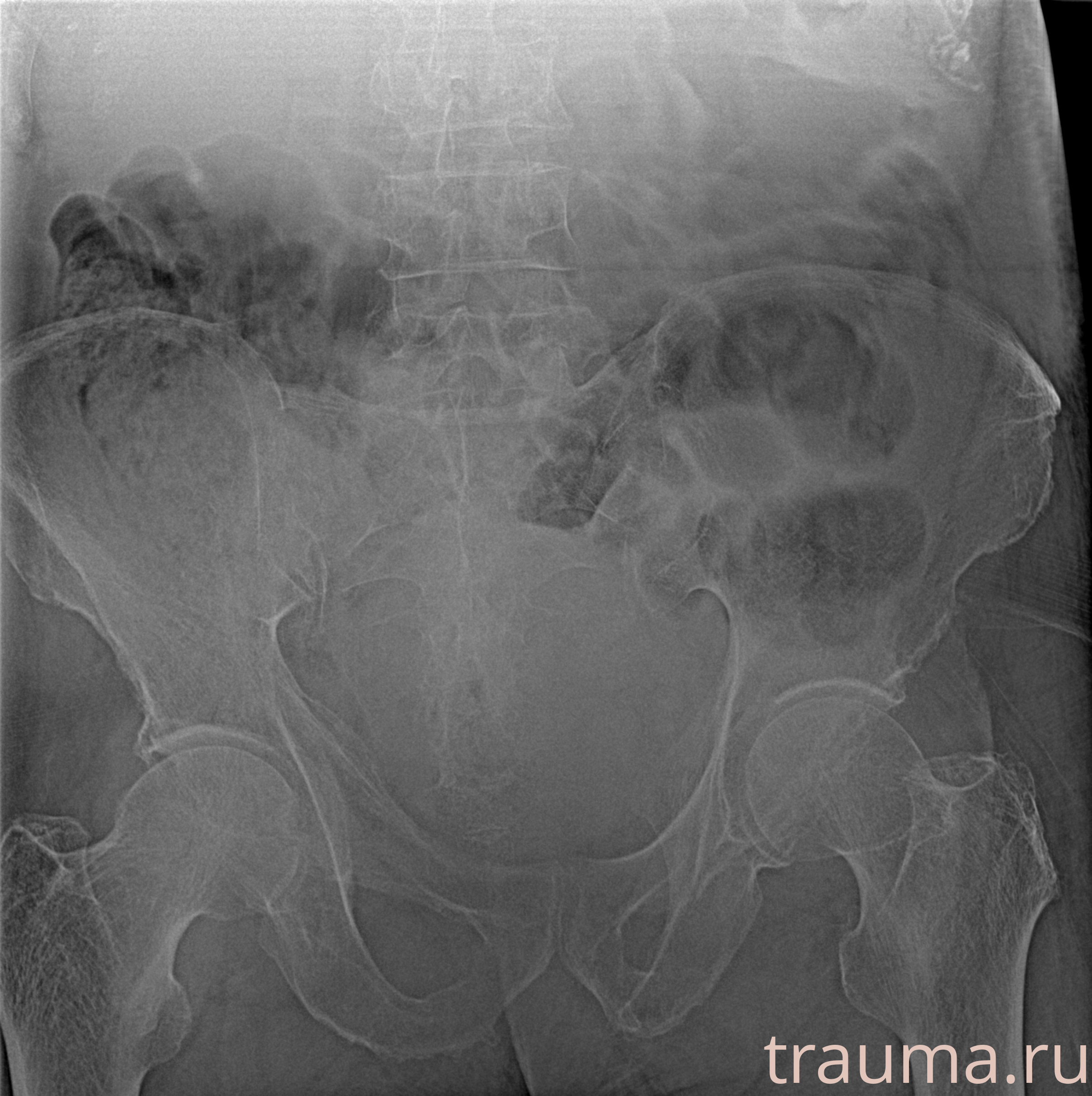 Рентген на дому: по вашему адресу приезжает врач-рентгенолог, травматолог-ортопед с мобильным рентгеновским аппаратом, проводит диагностику травмы или заболевания, делает необходимые рентгенограммы, дает рекомендации по дальнейшему лечению. Получить качественные снимки в домашних условиях возможно благодаря уникальной методике, разработанной МосРентген Центром для института  Склифосовского