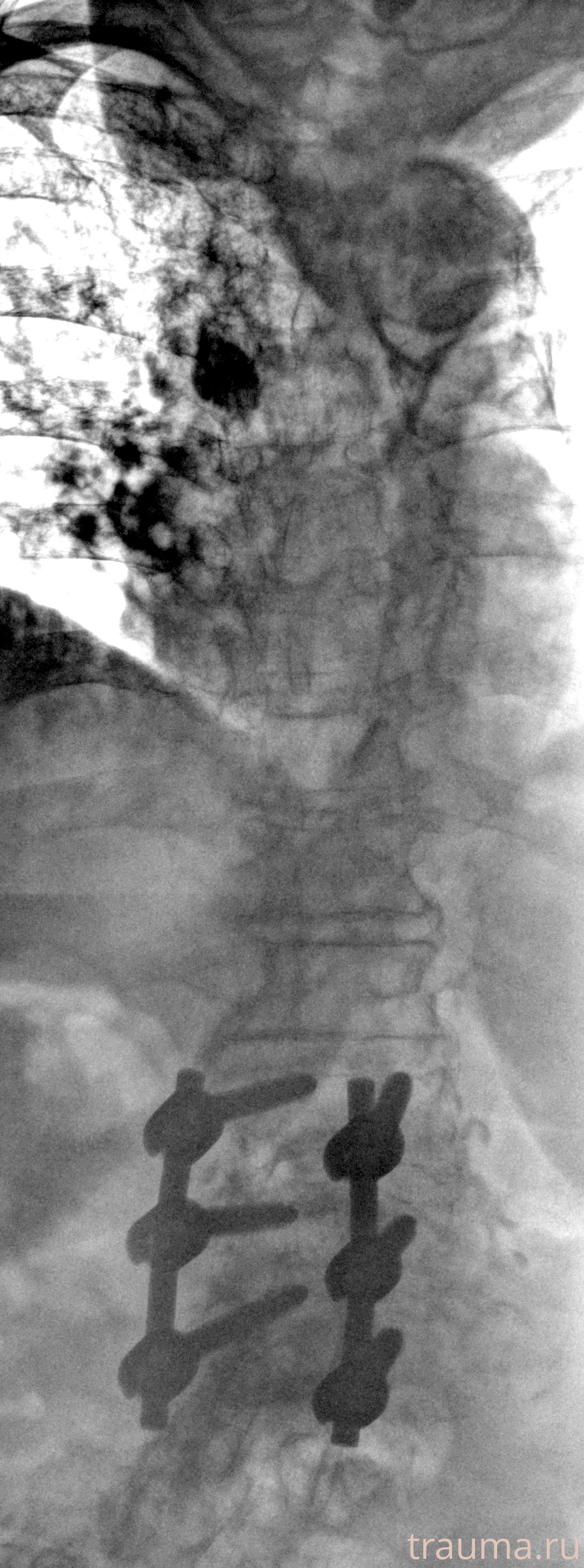 Рентген на дому: по вашему адресу приезжает врач-рентгенолог, травматолог-ортопед с мобильным рентгеновским аппаратом, проводит диагностику травмы или заболевания, делает необходимые рентгенограммы, дает рекомендации по дальнейшему лечению. Получить качественные снимки в домашних условиях возможно благодаря уникальной методике, разработанной МосРентген Центром для института  Склифосовского
