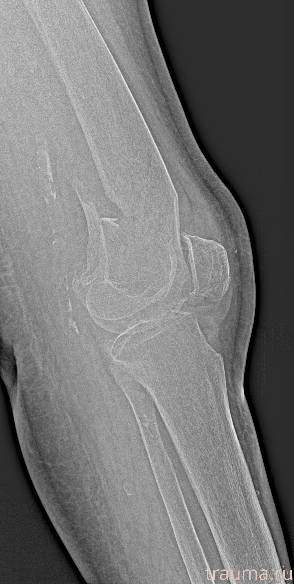 Рентген на дому: по вашему адресу приезжает врач-рентгенолог, травматолог-ортопед с мобильным рентгеновским аппаратом, проводит диагностику травмы или заболевания, делает необходимые рентгенограммы, дает рекомендации по дальнейшему лечению. Получить качественные снимки в домашних условиях возможно благодаря уникальной методике, разработанной МосРентген Центром для института  Склифосовского