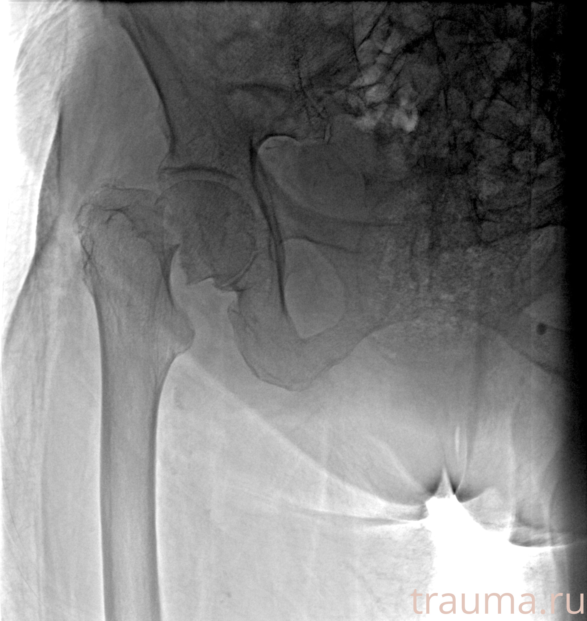 Рентген на дому: по вашему адресу приезжает врач-рентгенолог, травматолог-ортопед с мобильным рентгеновским аппаратом, проводит диагностику травмы или заболевания, делает необходимые рентгенограммы, дает рекомендации по дальнейшему лечению. Получить качественные снимки в домашних условиях возможно благодаря уникальной методике, разработанной МосРентген Центром для института  Склифосовского