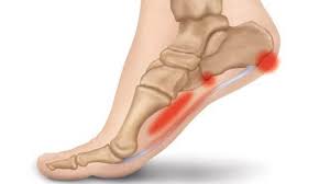 Методы лечения подошвенного фасциита или болезни “пяточной шпоры” 