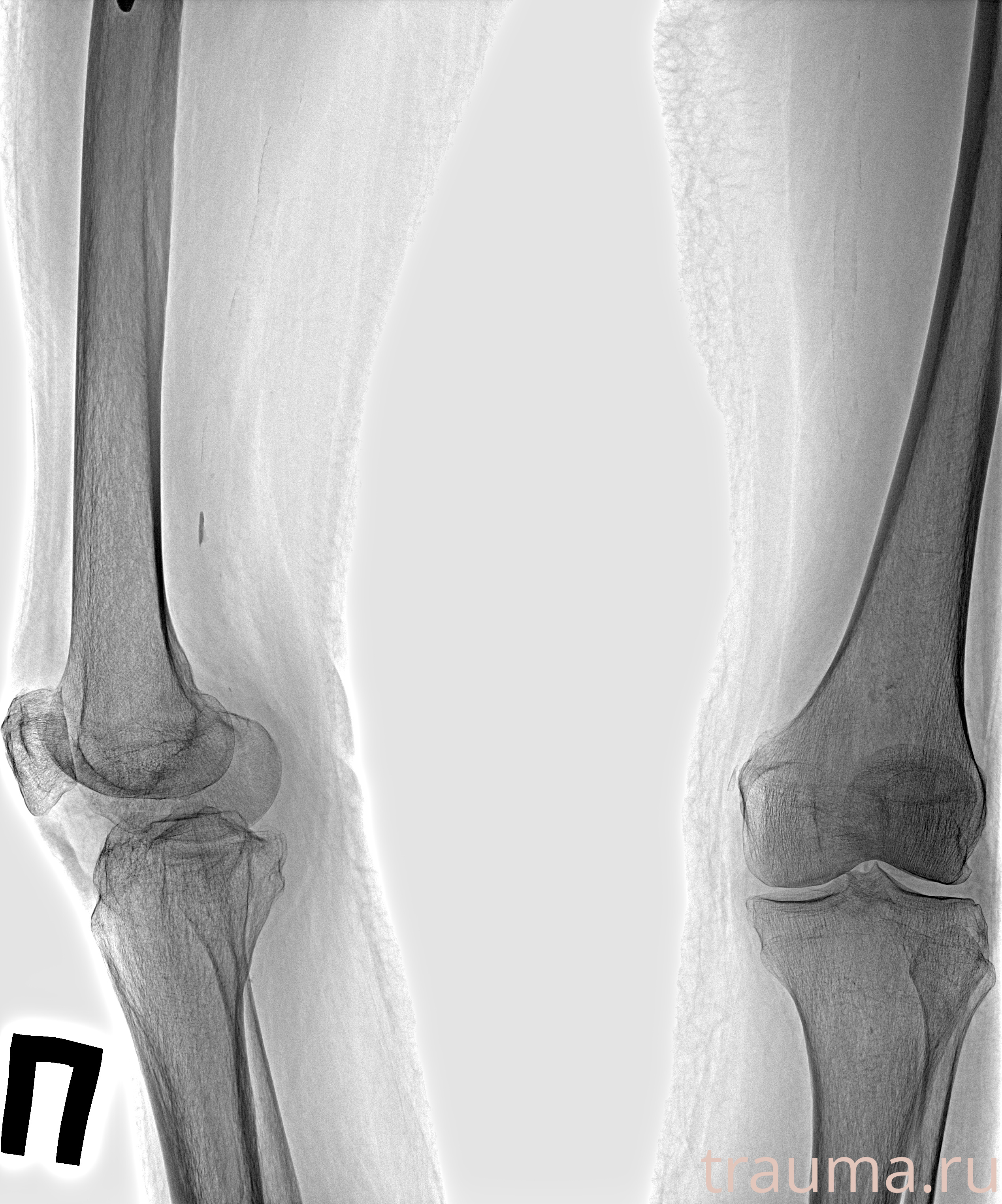 Рентген на дому: по вашему адресу приезжает врач-рентгенолог, травматолог-ортопед с мобильным рентгеновским аппаратом, проводит диагностику травмы или заболевания, делает необходимые рентгенограммы, дает рекомендации по дальнейшему лечению. Получить качественные снимки в домашних условиях возможно благодаря уникальной методике, разработанной МосРентген Центром для института  Склифосовского