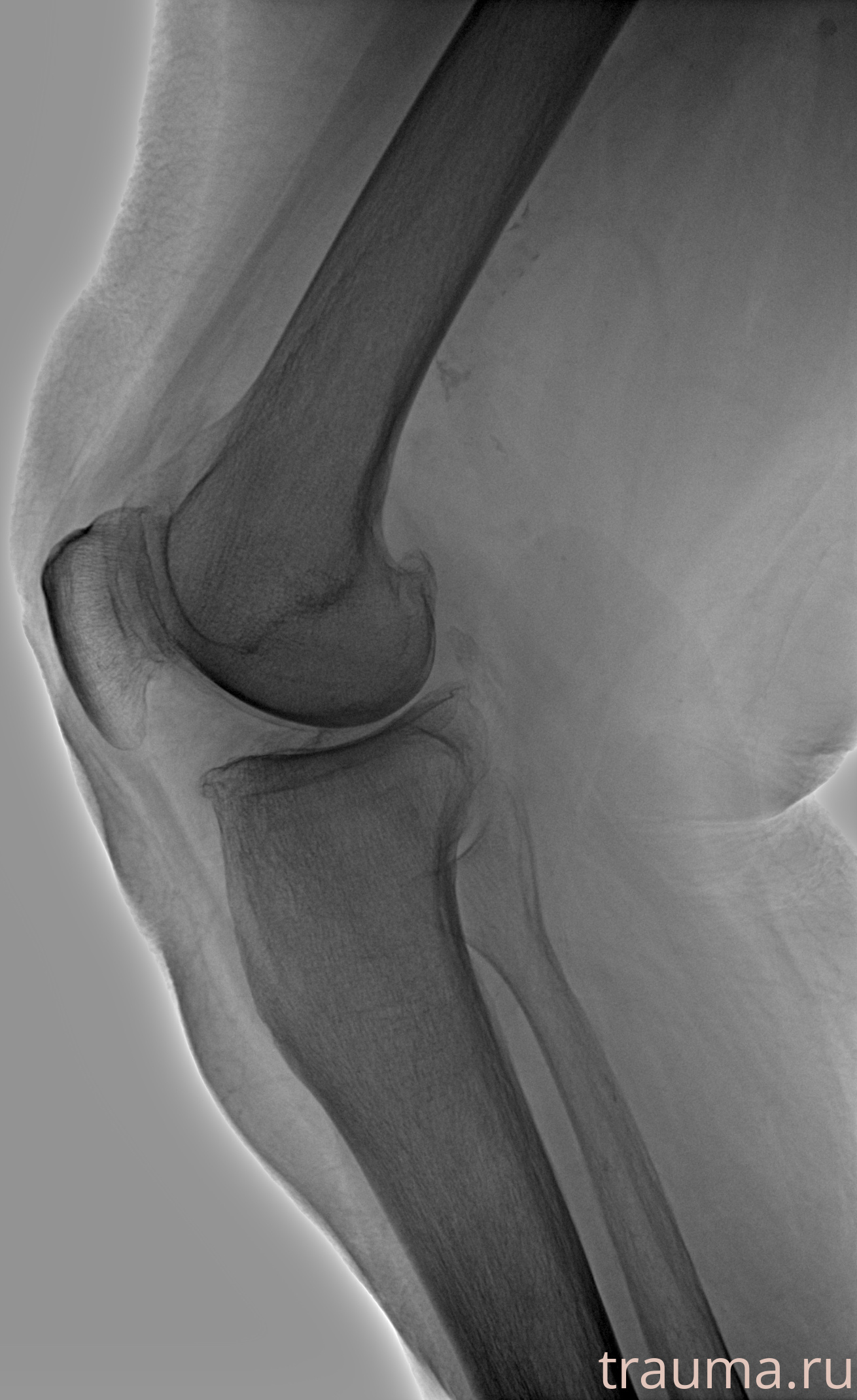 Рентген на дому: по вашему адресу приезжает врач-рентгенолог, травматолог-ортопед с мобильным рентгеновским аппаратом, проводит диагностику травмы или заболевания, делает необходимые рентгенограммы, дает рекомендации по дальнейшему лечению. Получить качественные снимки в домашних условиях возможно благодаря уникальной методике, разработанной МосРентген Центром для института  Склифосовского