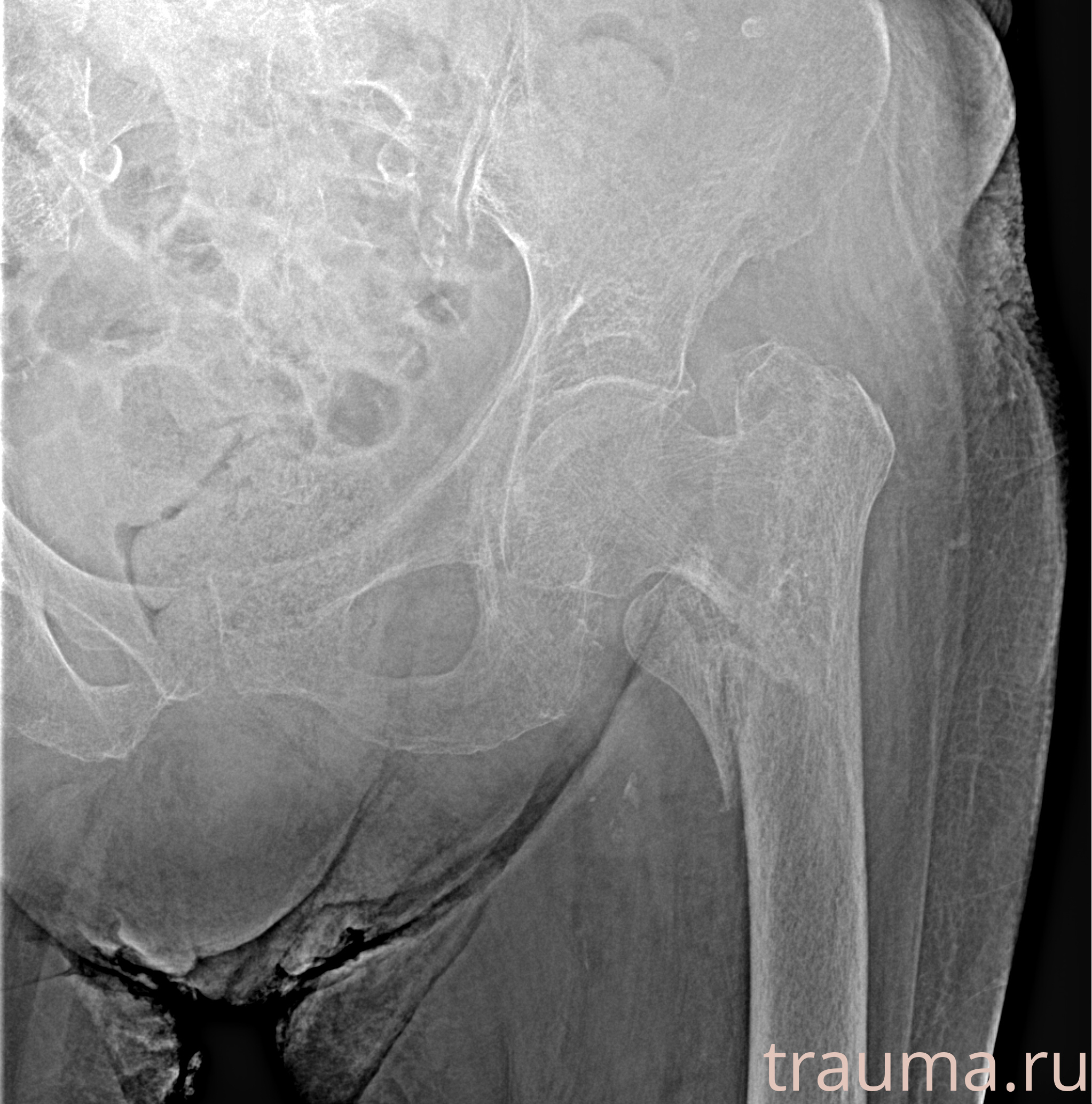 Рентген на дому: по вашему адресу приезжает врач-рентгенолог, травматолог-ортопед с мобильным рентгеновским аппаратом, проводит диагностику травмы или заболевания, делает необходимые рентгенограммы, дает рекомендации по дальнейшему лечению. Получить качественные снимки в домашних условиях возможно благодаря уникальной методике, разработанной МосРентген Центром для института  Склифосовского