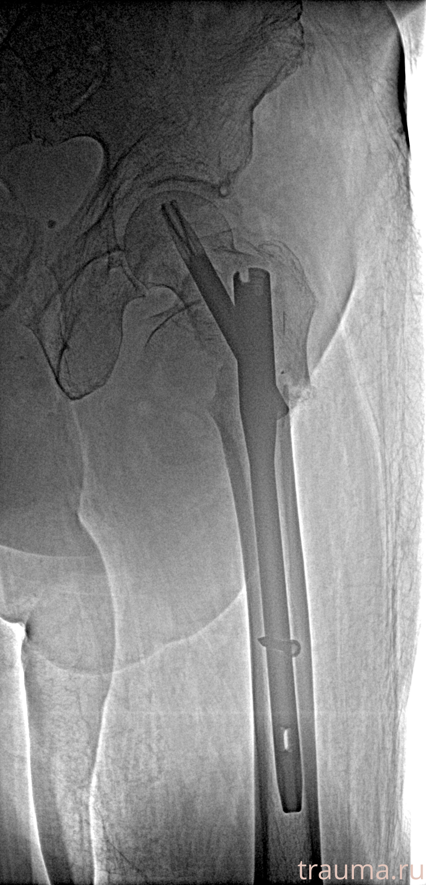 Рентген на дому: по вашему адресу приезжает врач-рентгенолог, травматолог-ортопед с мобильным рентгеновским аппаратом, проводит диагностику травмы или заболевания, делает необходимые рентгенограммы, дает рекомендации по дальнейшему лечению. Получить качественные снимки в домашних условиях возможно благодаря уникальной методике, разработанной МосРентген Центром для института  Склифосовского