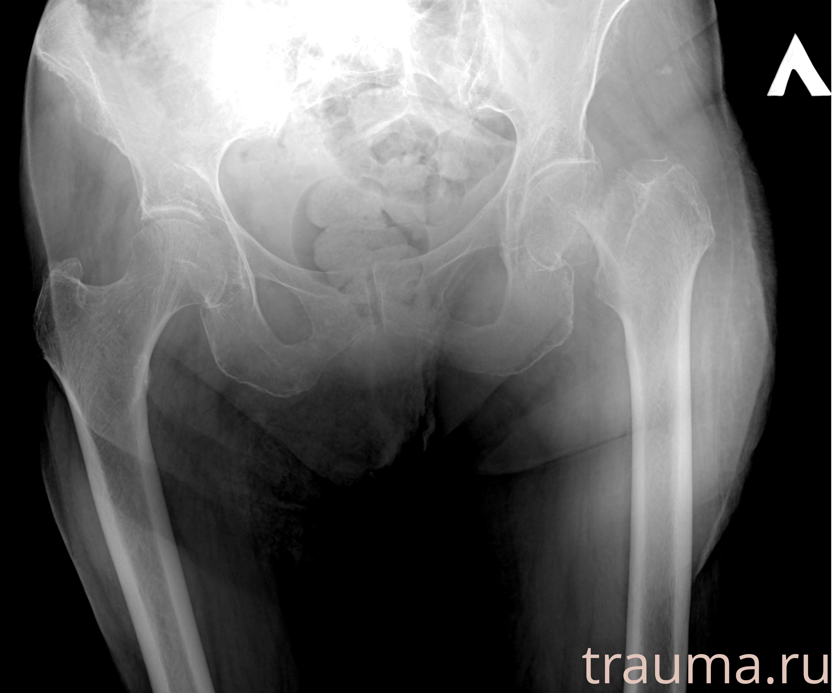 Рентген на дому: по вашему адресу приезжает врач-рентгенолог, травматолог-ортопед с мобильным рентгеновским аппаратом, проводит диагностику травмы или заболевания, делает необходимые рентгенограммы, дает рекомендации по дальнейшему лечению. Получить качественные снимки в домашних условиях возможно благодаря уникальной методике, разработанной МосРентген Центром для института  Склифосовского