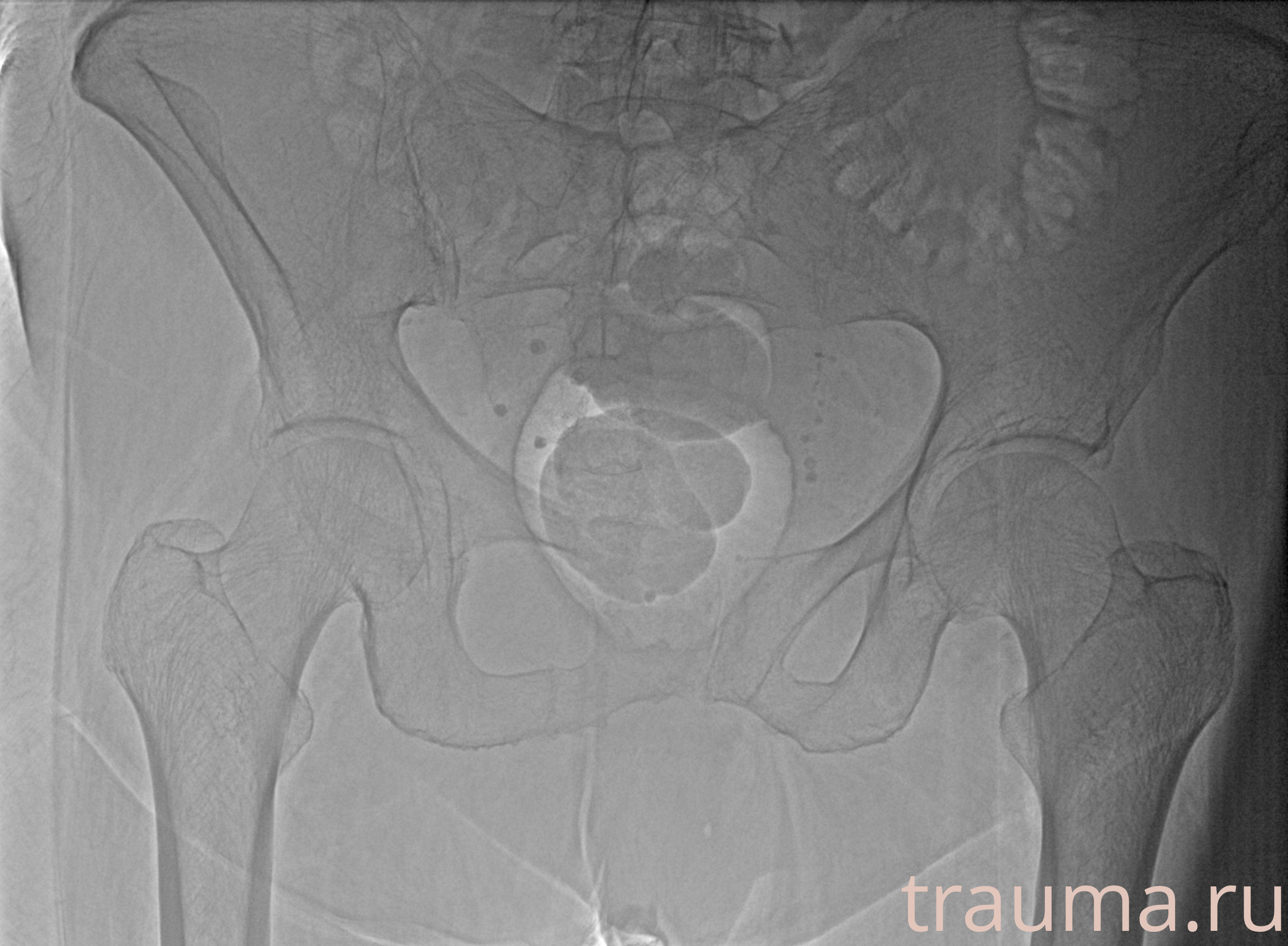 Рентген на дому: по вашему адресу приезжает врач-рентгенолог, травматолог-ортопед с мобильным рентгеновским аппаратом, проводит диагностику травмы или заболевания, делает необходимые рентгенограммы, дает рекомендации по дальнейшему лечению. Получить качественные снимки в домашних условиях возможно благодаря уникальной методике, разработанной МосРентген Центром для института  Склифосовского
