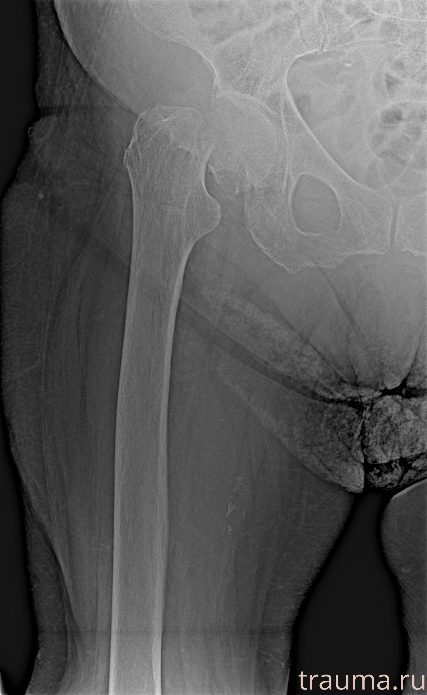 Рентген на дому: по вашему адресу приезжает врач-рентгенолог, травматолог-ортопед с мобильным рентгеновским аппаратом, проводит диагностику травмы или заболевания, делает необходимые рентгенограммы, дает рекомендации по дальнейшему лечению. Получить качественные снимки в домашних условиях возможно благодаря уникальной методике, разработанной МосРентген Центром для института  Склифосовского