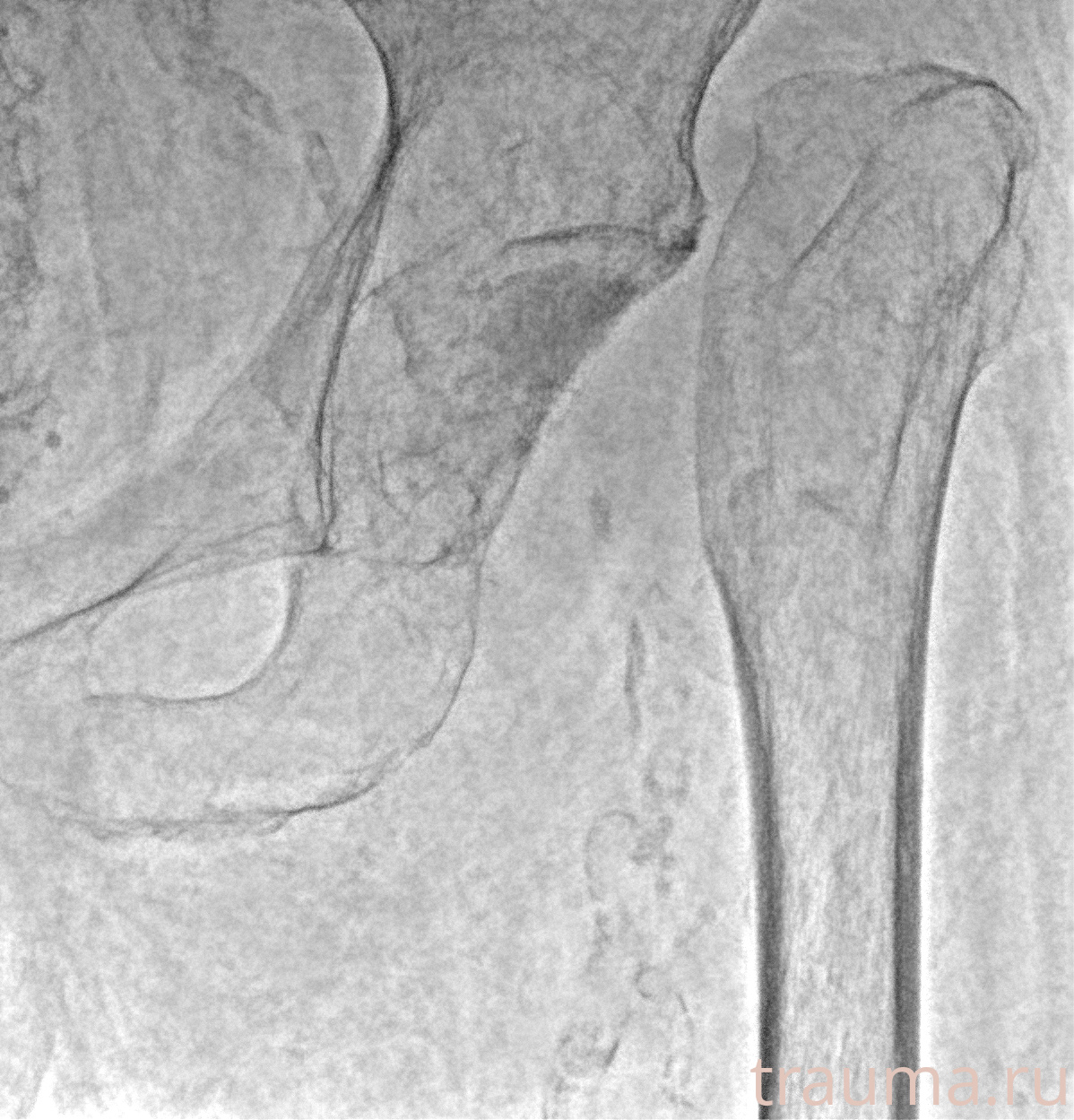 Рентген на дому: по вашему адресу приезжает врач-рентгенолог, травматолог-ортопед с мобильным рентгеновским аппаратом, проводит диагностику травмы или заболевания, делает необходимые рентгенограммы, дает рекомендации по дальнейшему лечению. Получить качественные снимки в домашних условиях возможно благодаря уникальной методике, разработанной МосРентген Центром для института  Склифосовского