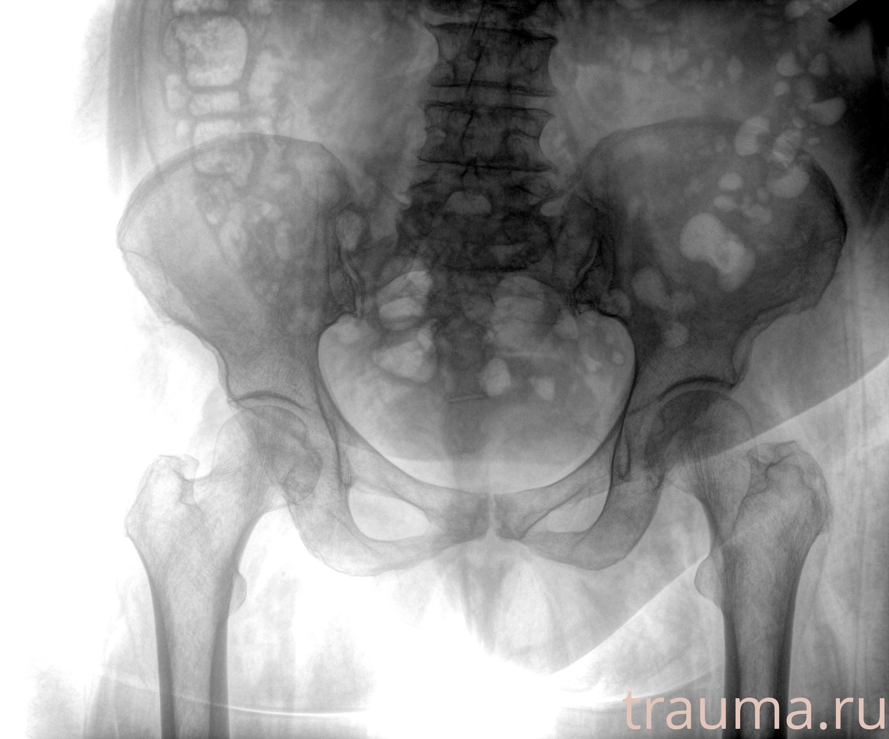 Рентген на дому: по вашему адресу приезжает врач-рентгенолог, травматолог-ортопед с мобильным рентгеновским аппаратом, проводит диагностику травмы или заболевания, делает необходимые рентгенограммы, дает рекомендации по дальнейшему лечению. Получить качественные снимки в домашних условиях возможно благодаря уникальной методике, разработанной МосРентген Центром для института  Склифосовского
