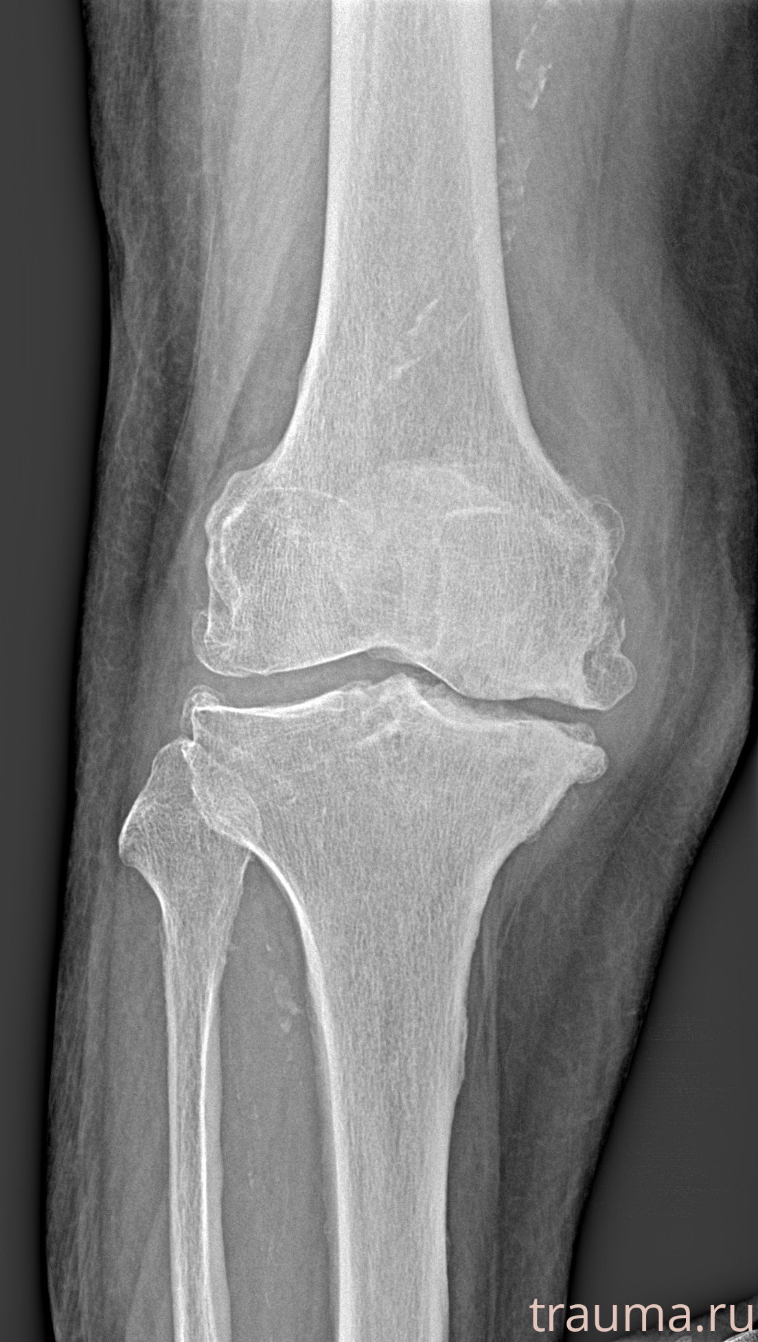 Рентген на дому: по вашему адресу приезжает врач-рентгенолог, травматолог-ортопед с мобильным рентгеновским аппаратом, проводит диагностику травмы или заболевания, делает необходимые рентгенограммы, дает рекомендации по дальнейшему лечению. Получить качественные снимки в домашних условиях возможно благодаря уникальной методике, разработанной МосРентген Центром для института  Склифосовского