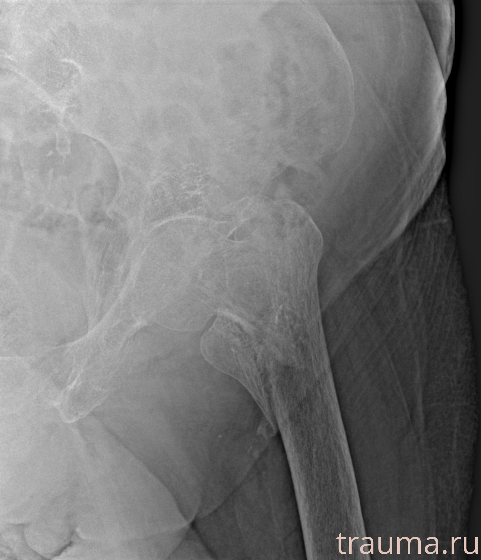 Рентген на дому: по вашему адресу приезжает врач-рентгенолог, травматолог-ортопед с мобильным рентгеновским аппаратом, проводит диагностику травмы или заболевания, делает необходимые рентгенограммы, дает рекомендации по дальнейшему лечению. Получить качественные снимки в домашних условиях возможно благодаря уникальной методике, разработанной МосРентген Центром для института  Склифосовского