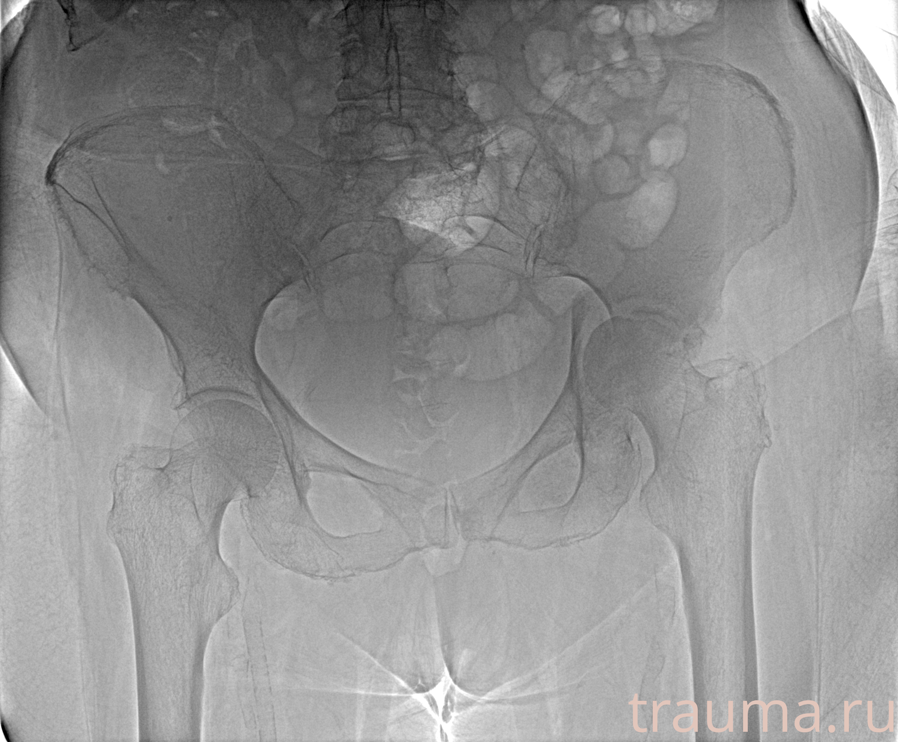 Рентген на дому: по вашему адресу приезжает врач-рентгенолог, травматолог-ортопед с мобильным рентгеновским аппаратом, проводит диагностику травмы или заболевания, делает необходимые рентгенограммы, дает рекомендации по дальнейшему лечению. Получить качественные снимки в домашних условиях возможно благодаря уникальной методике, разработанной МосРентген Центром для института  Склифосовского