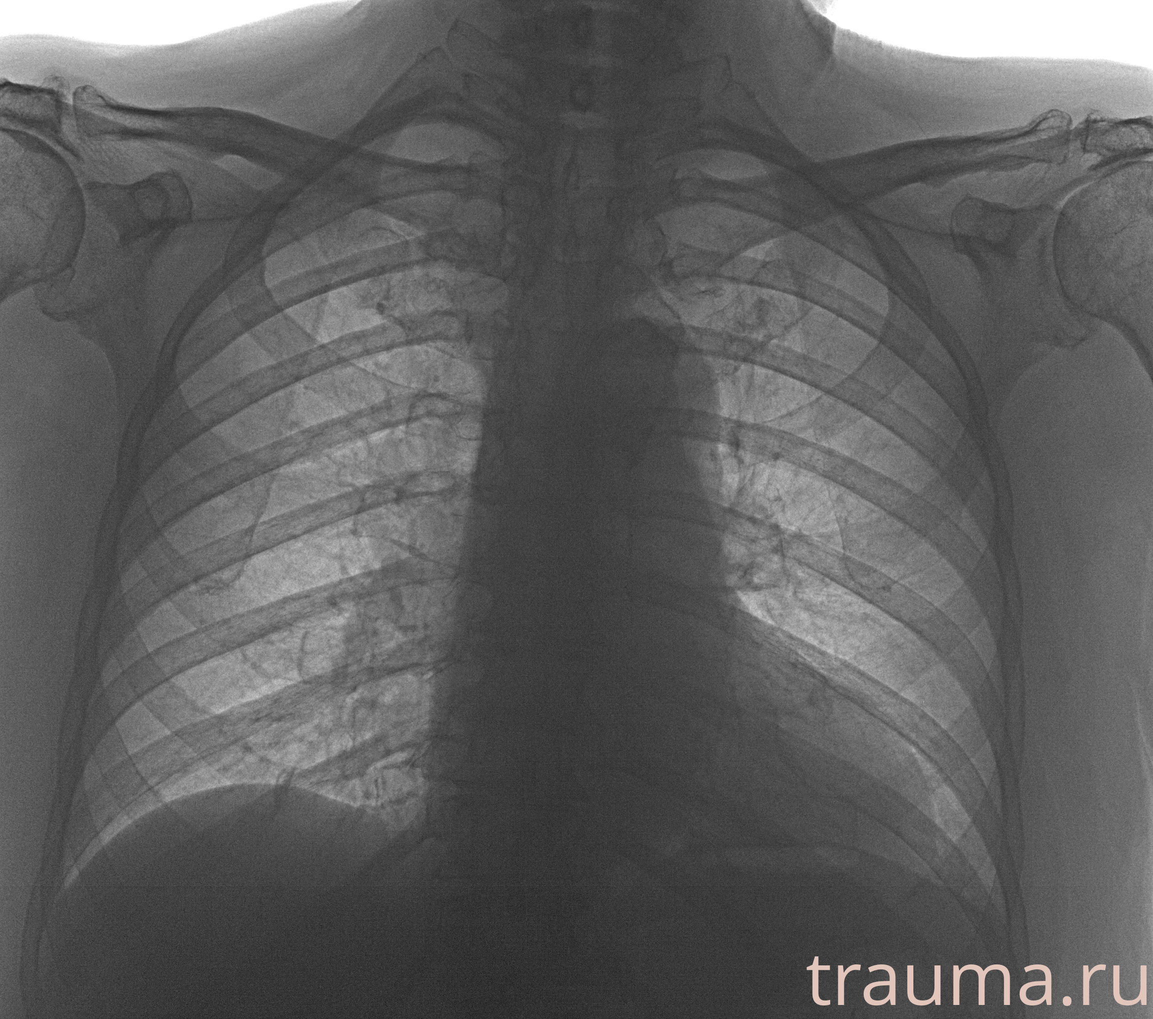 Рентген на дому: по вашему адресу приезжает врач-рентгенолог, травматолог-ортопед с мобильным рентгеновским аппаратом, проводит диагностику травмы или заболевания, делает необходимые рентгенограммы, дает рекомендации по дальнейшему лечению. Получить качественные снимки в домашних условиях возможно благодаря уникальной методике, разработанной МосРентген Центром для института  Склифосовского